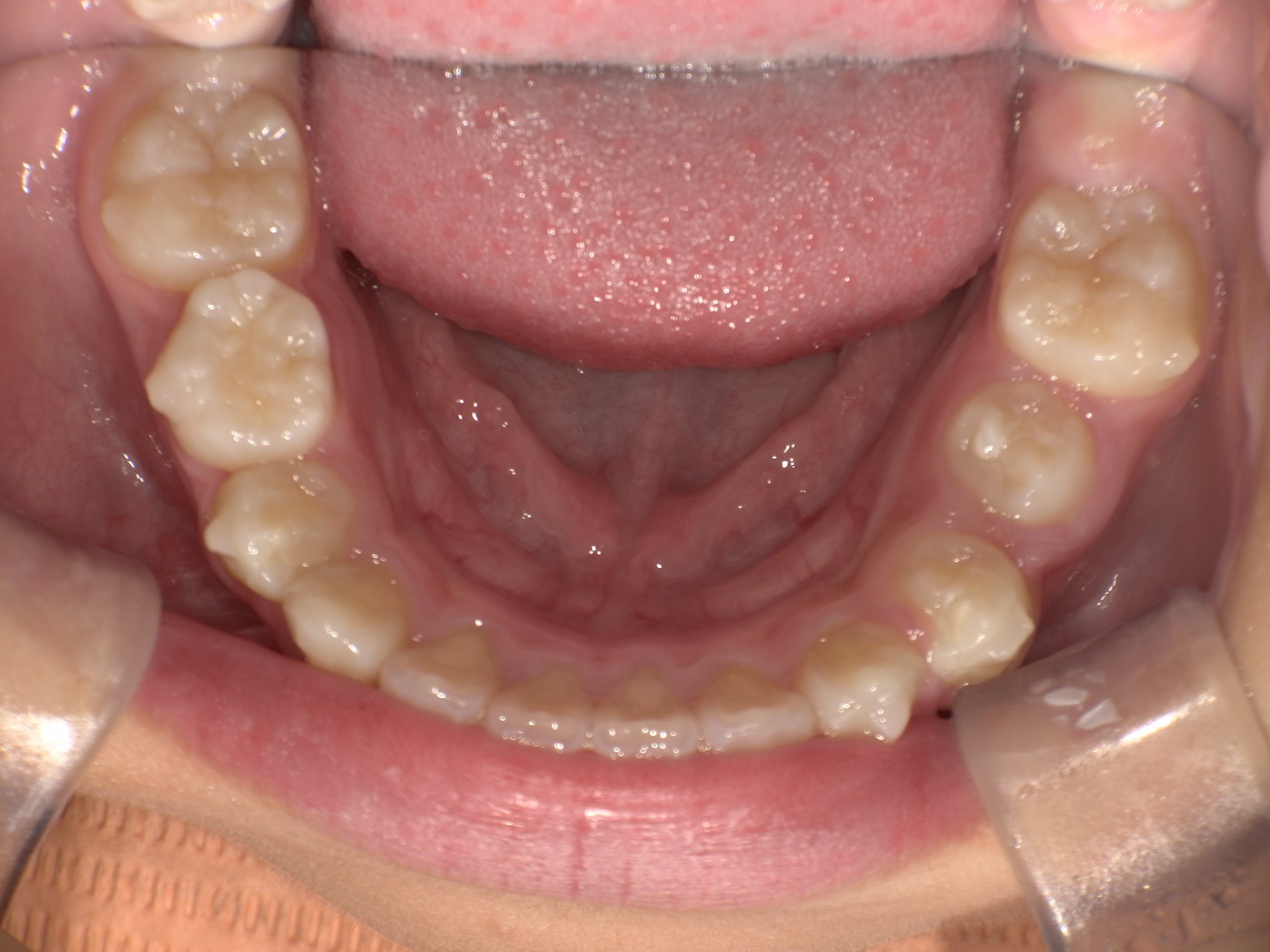 インビザラインファースト