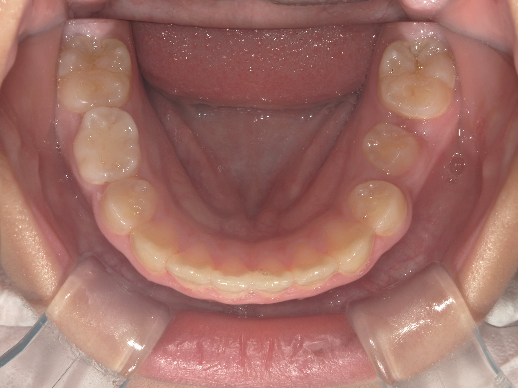 インビザラインファースト