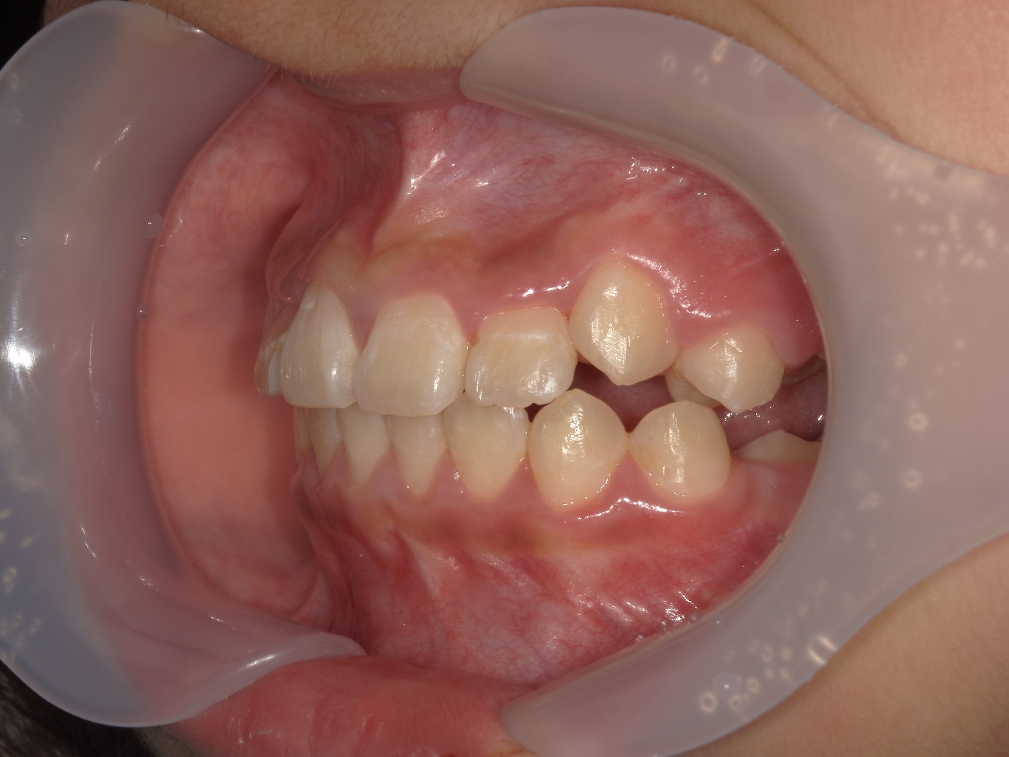 インビザラインファースト