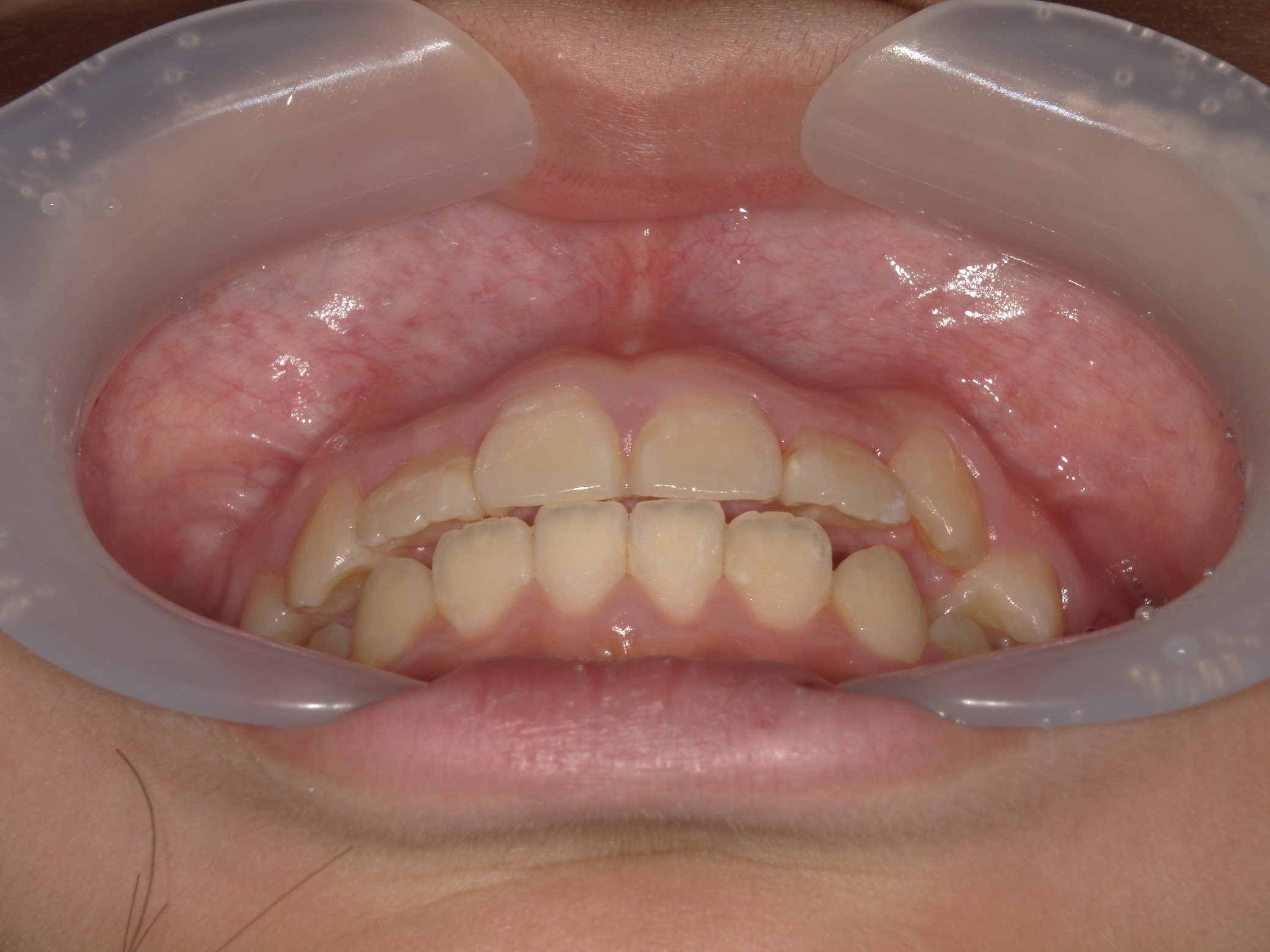 インビザラインファースト