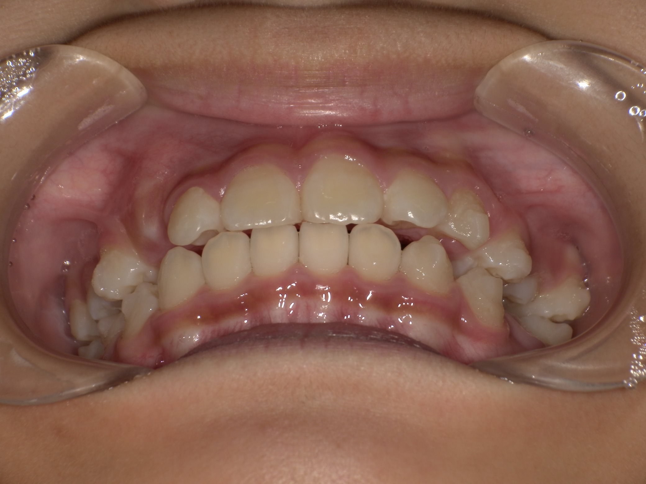 インビザラインファースト