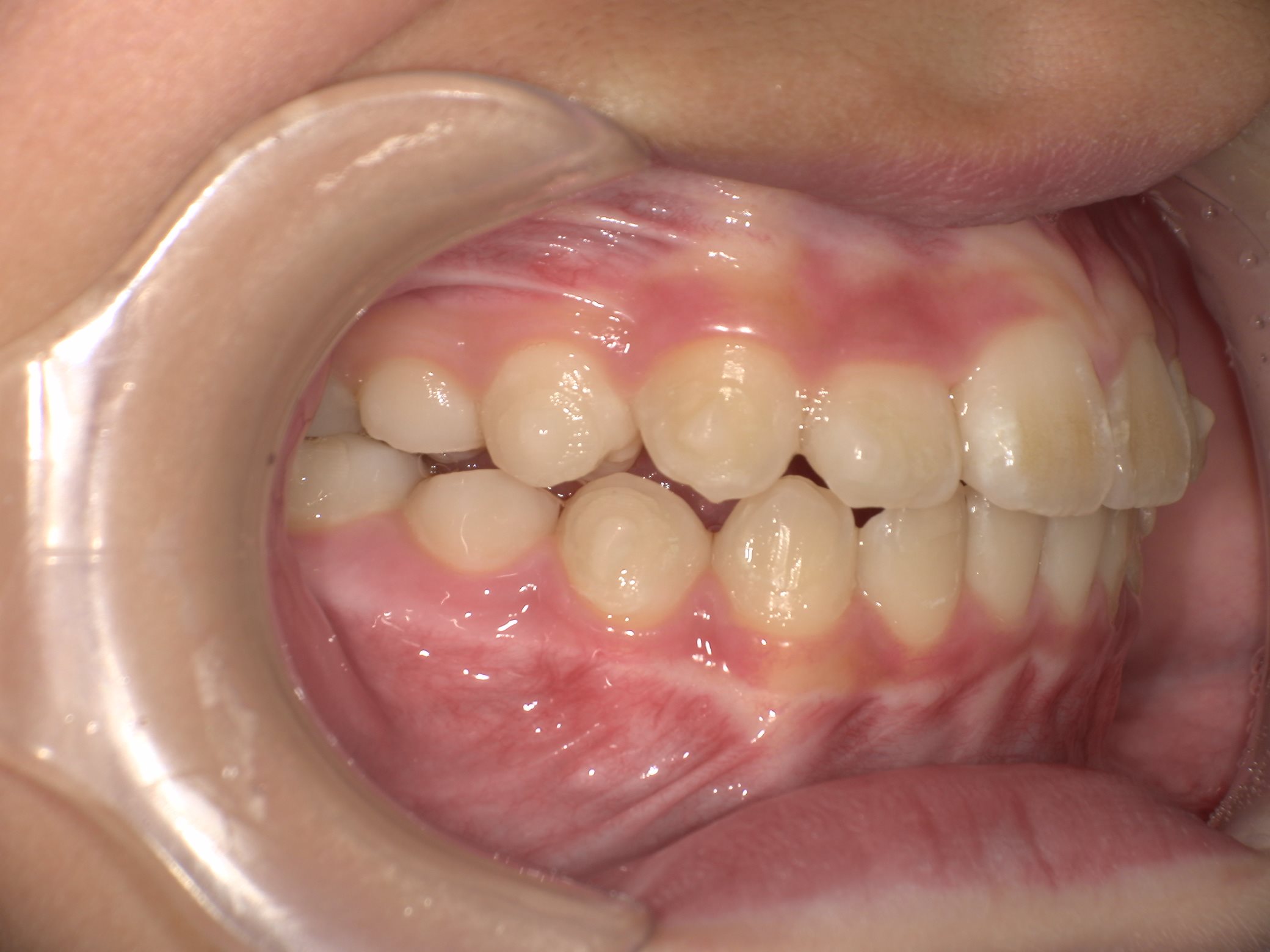 インビザラインファースト