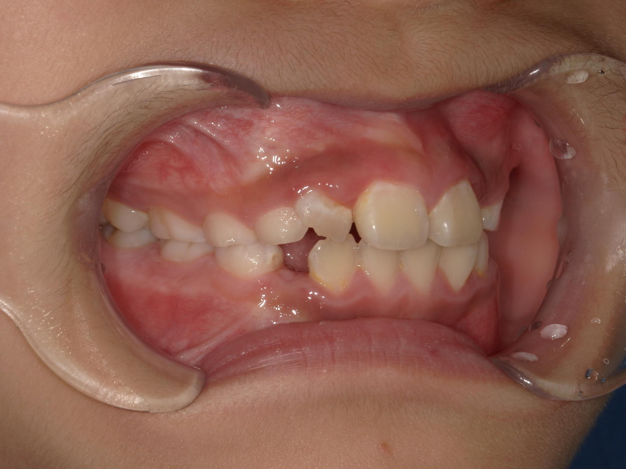 インビザラインファースト