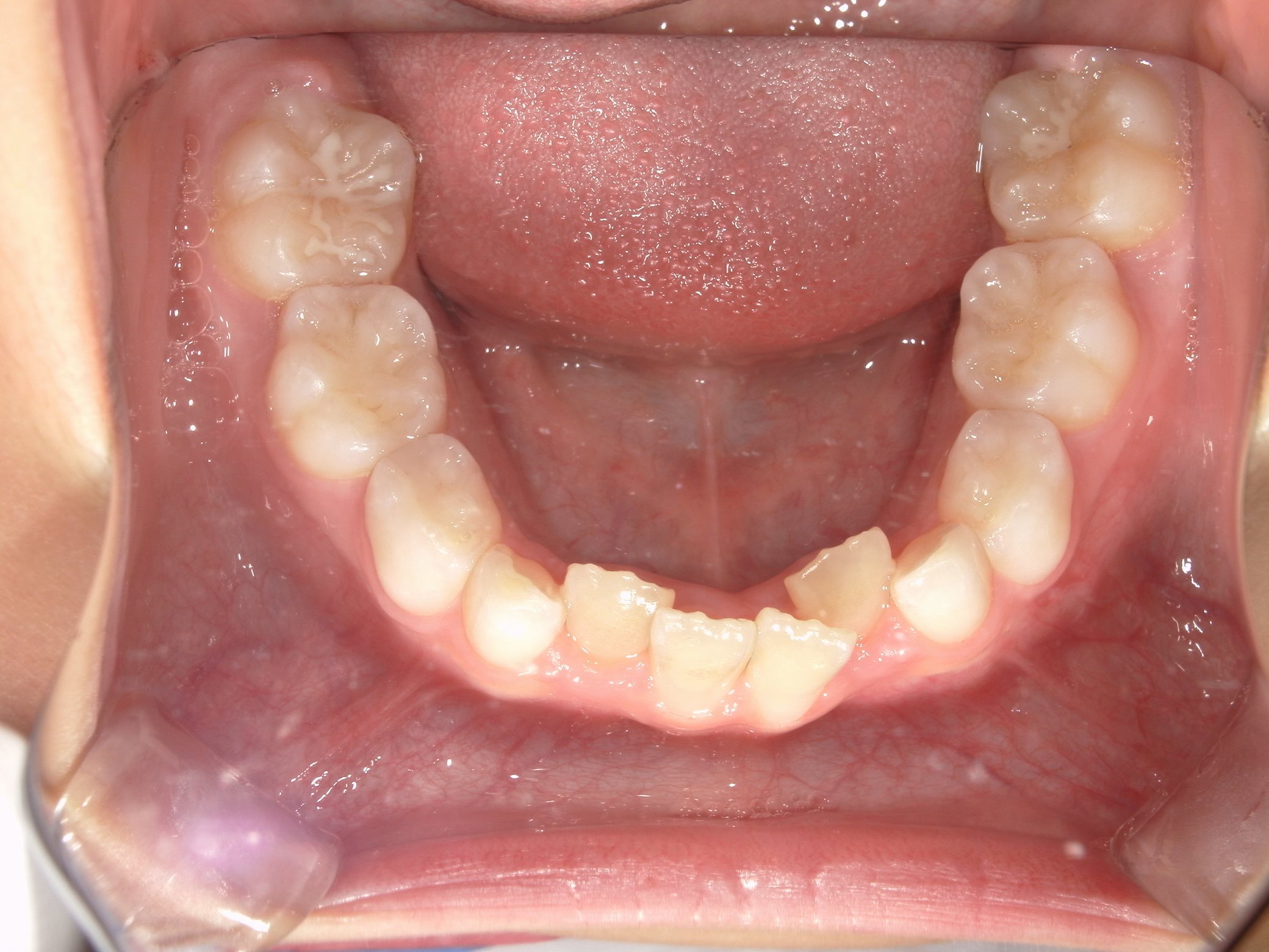 インビザラインファースト