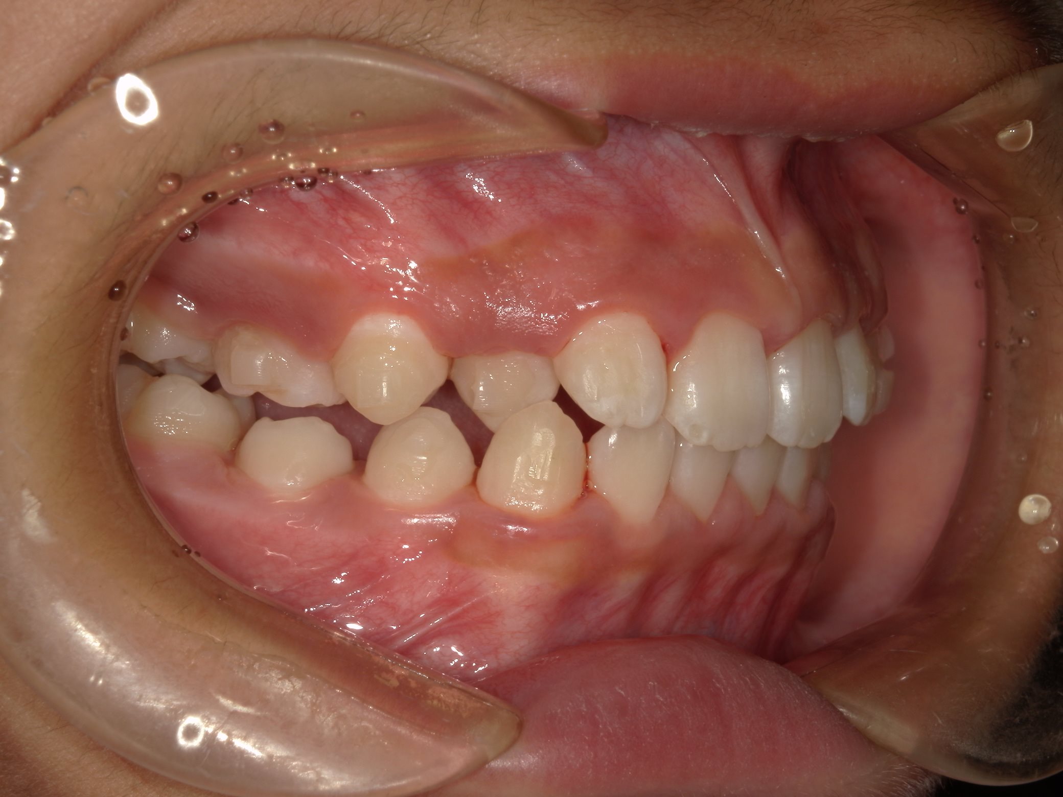 インビザラインファースト