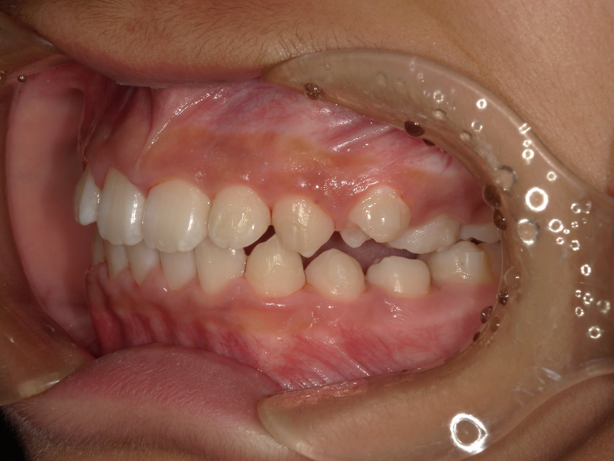 インビザラインファースト