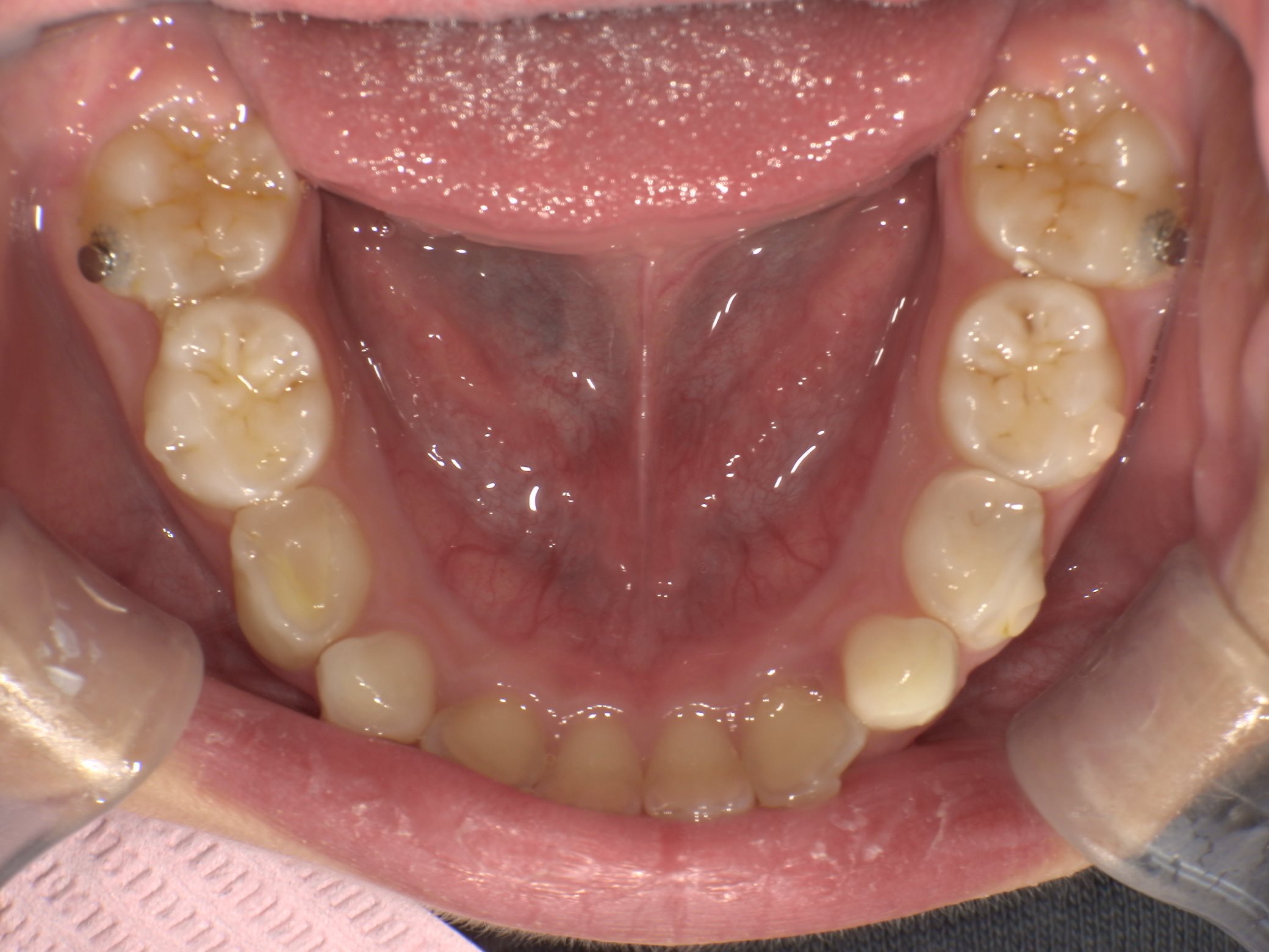 インビザラインファースト