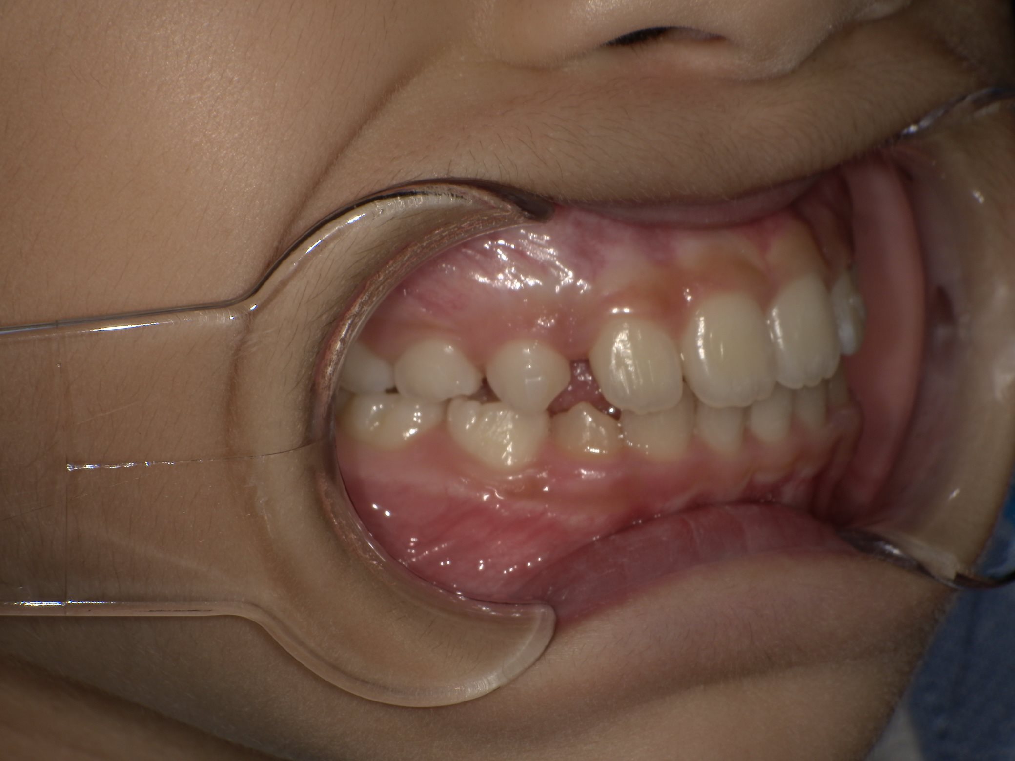 インビザラインファースト