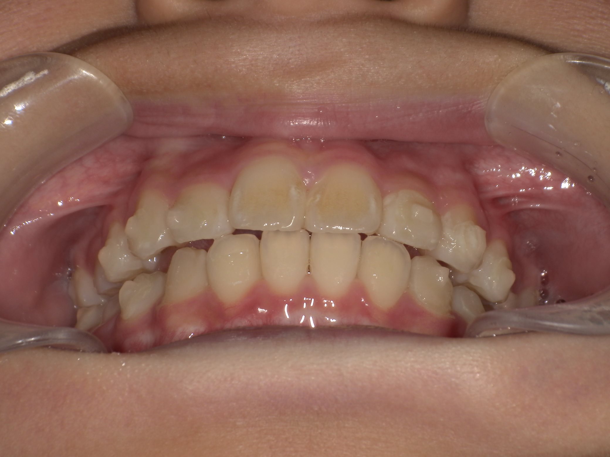 インビザラインファースト