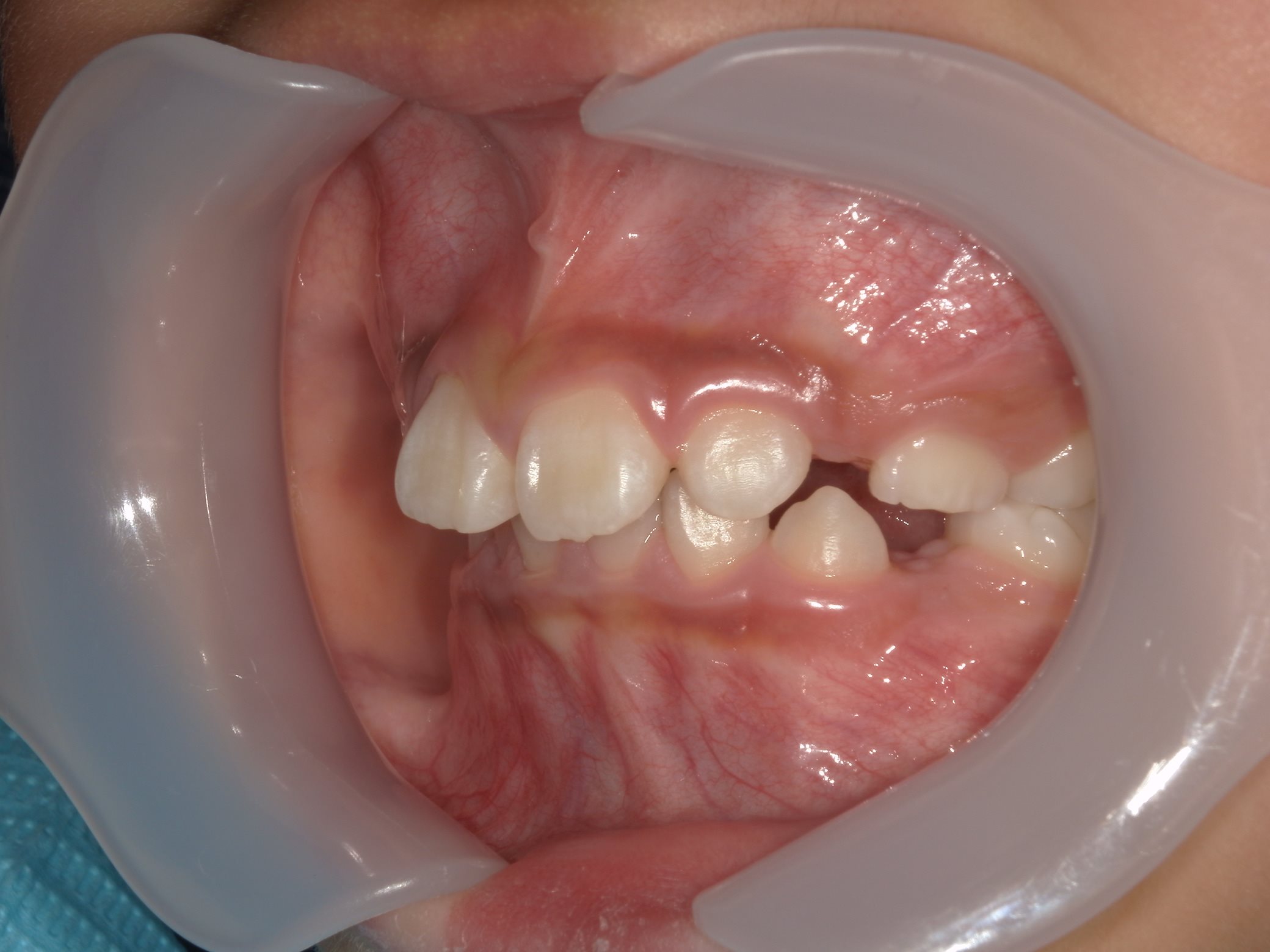 インビザラインファースト