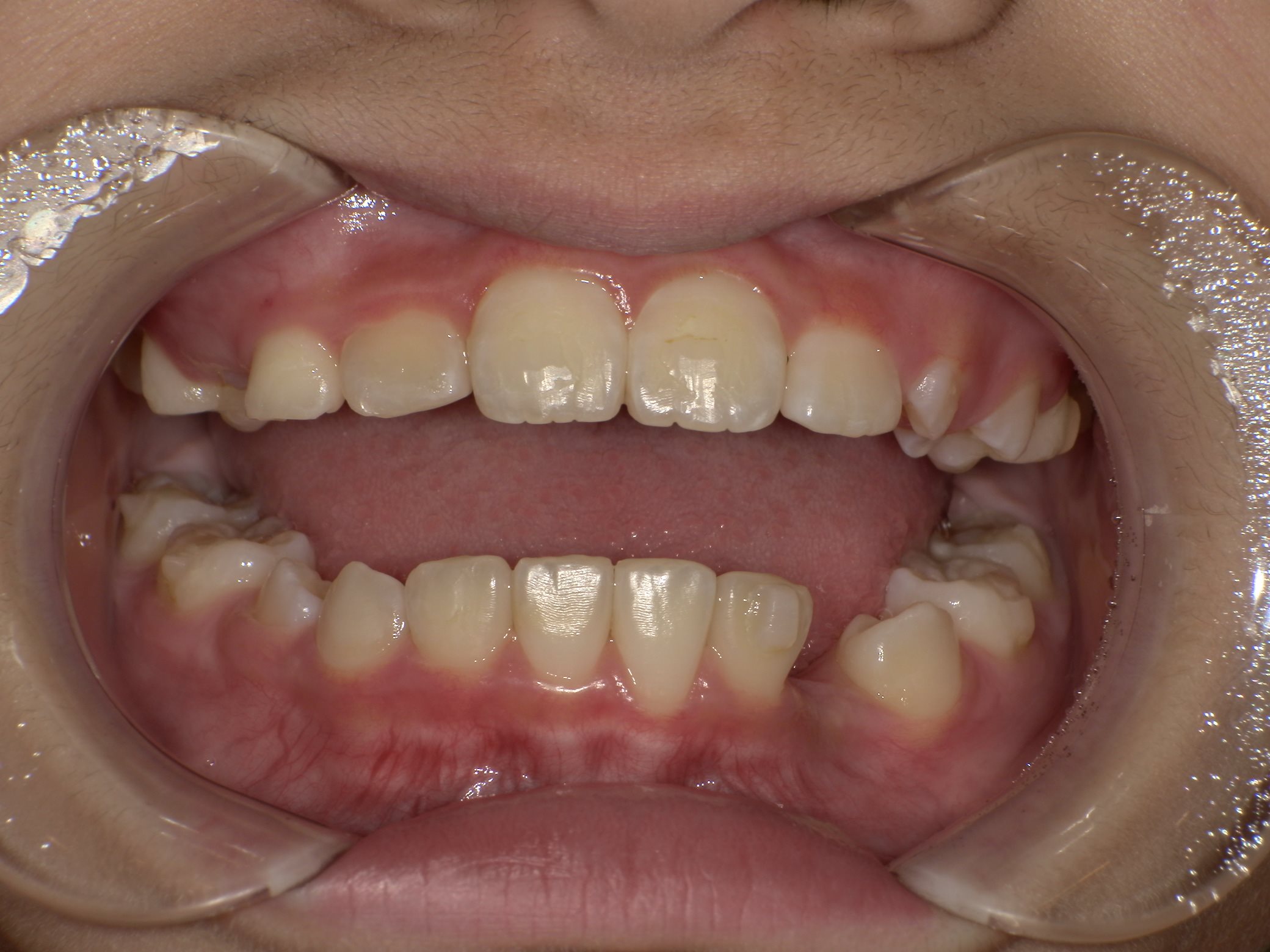 インビザラインファースト