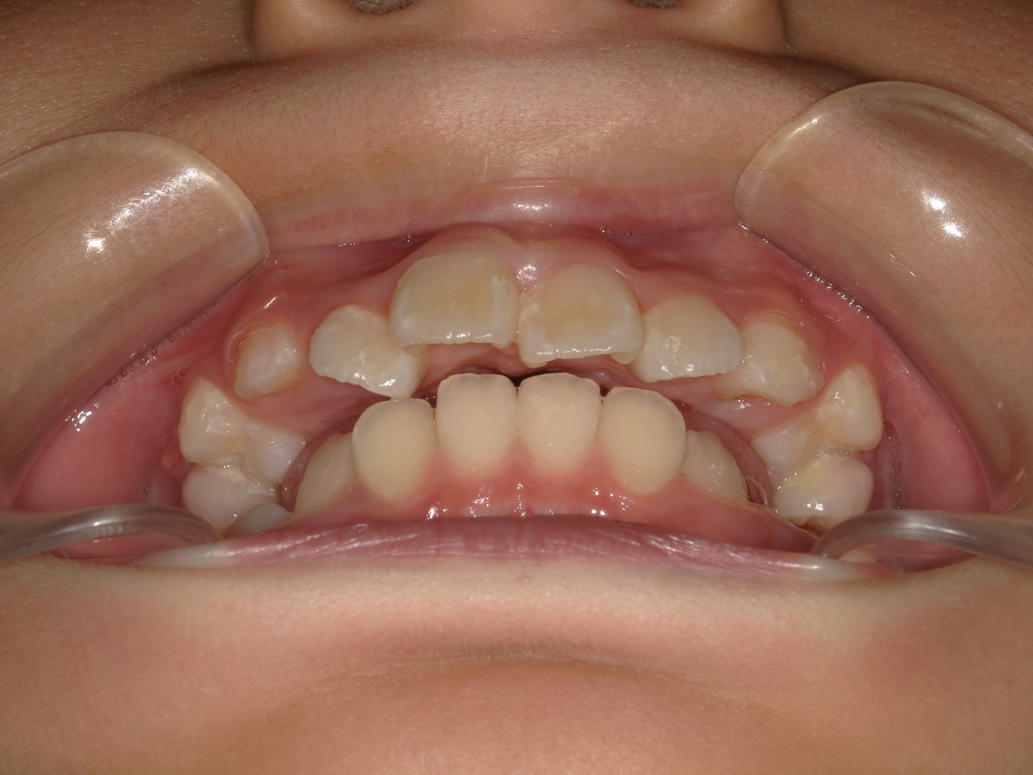 インビザラインファースト