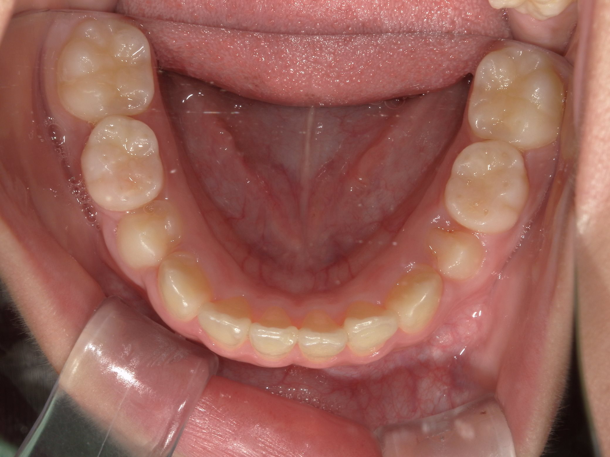 インビザラインファースト