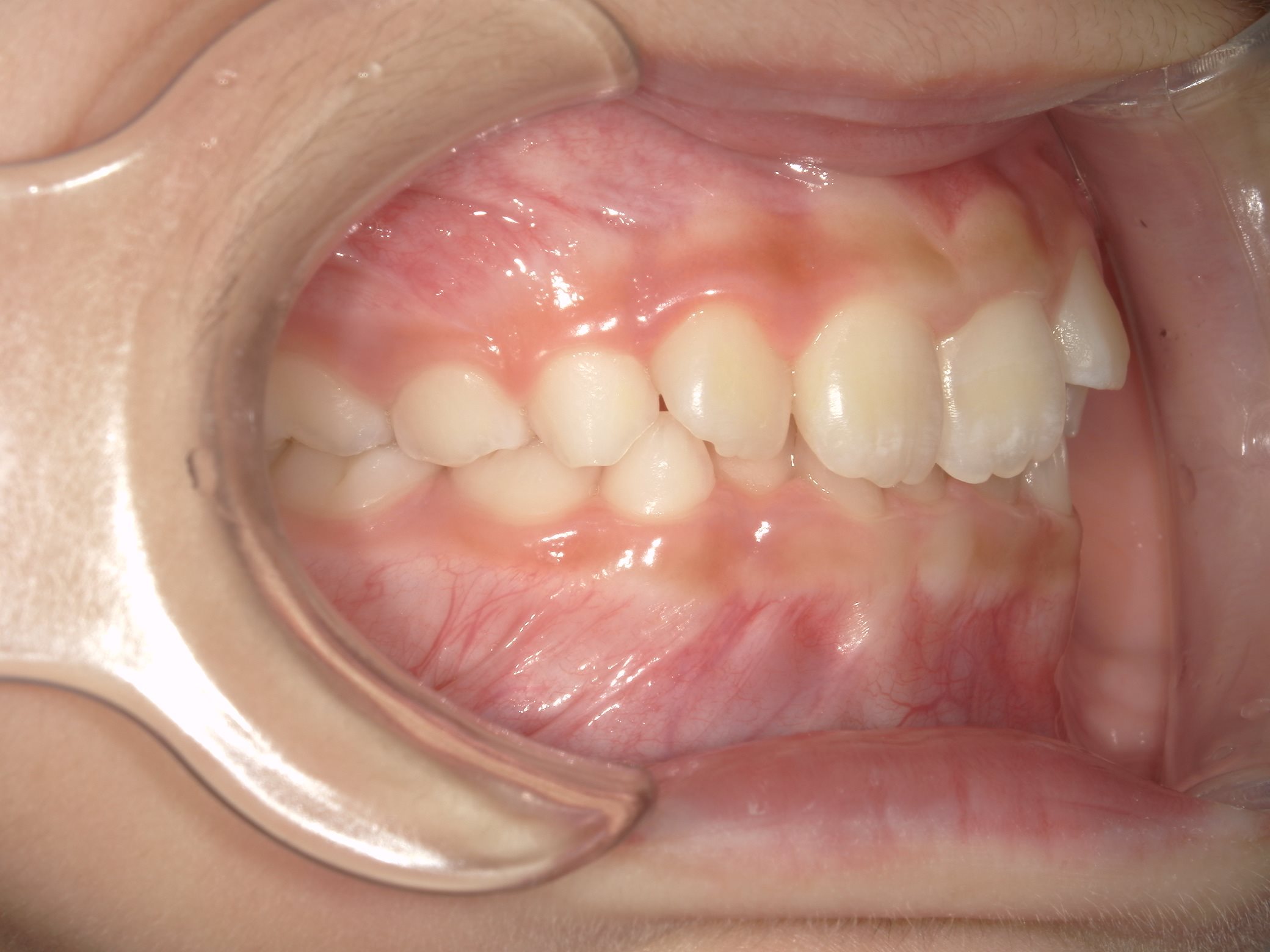 インビザラインファースト