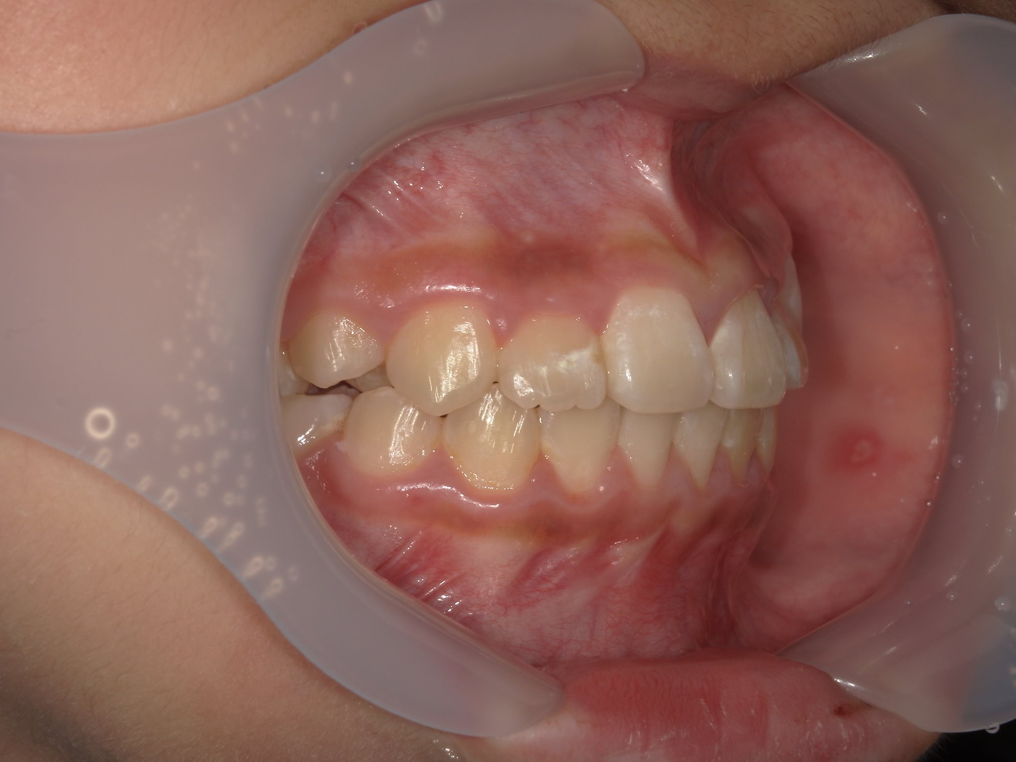 インビザラインファースト