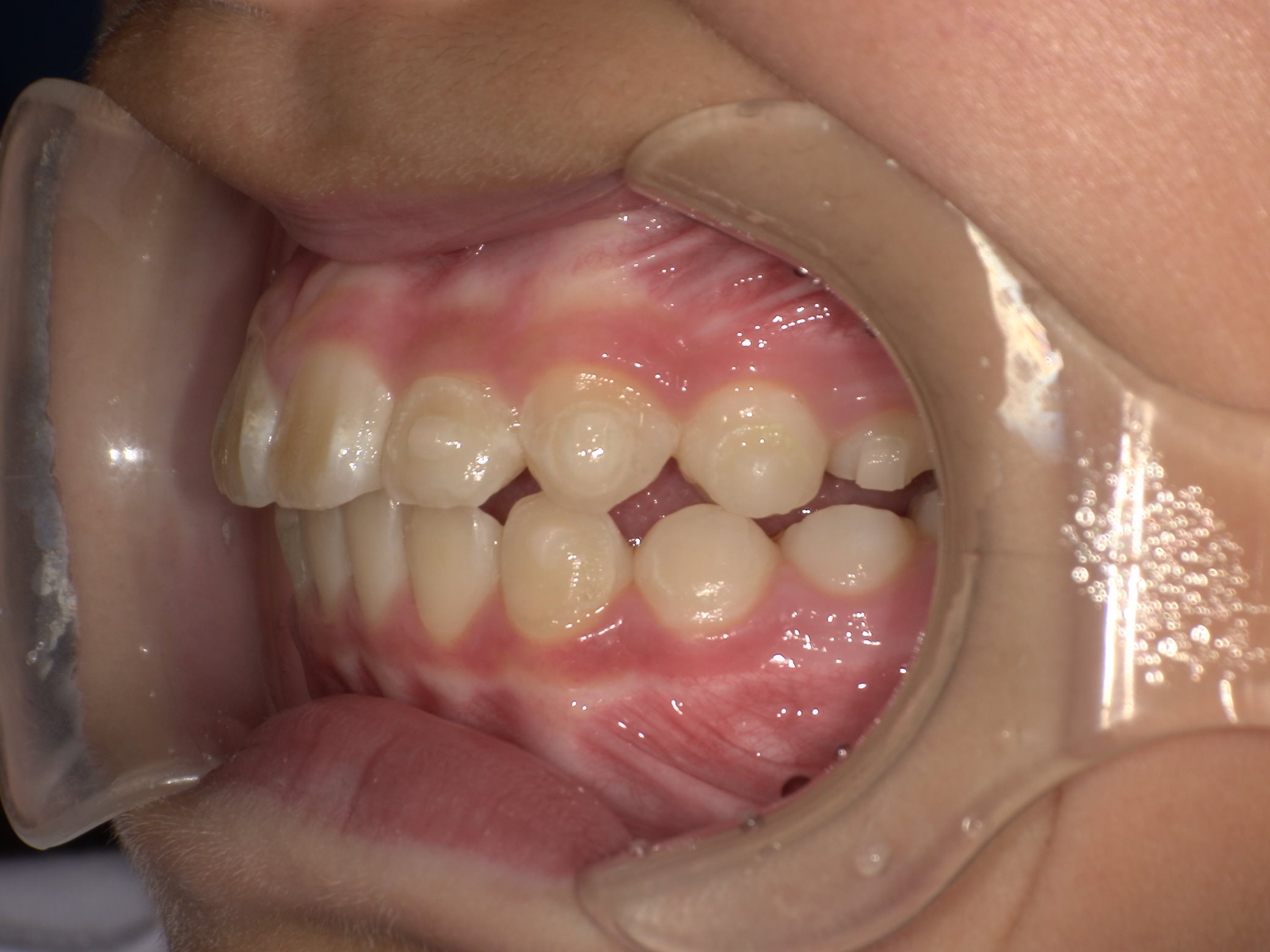 インビザラインファースト