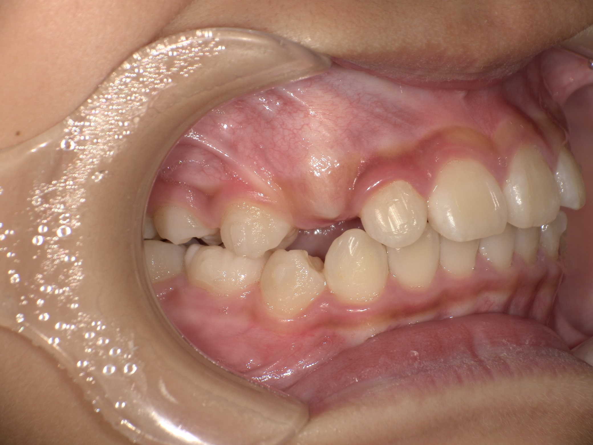 インビザラインファースト