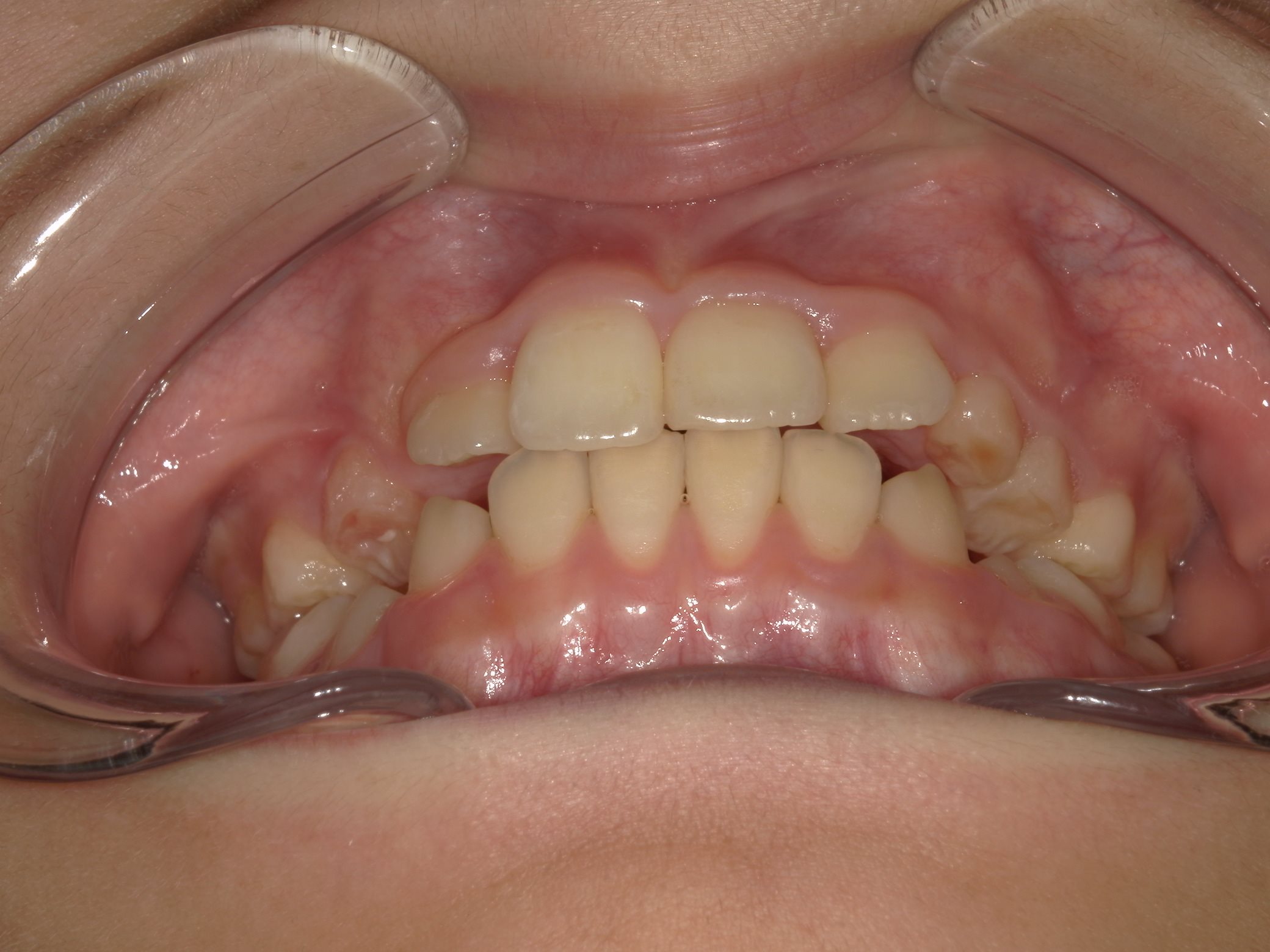 インビザラインファースト