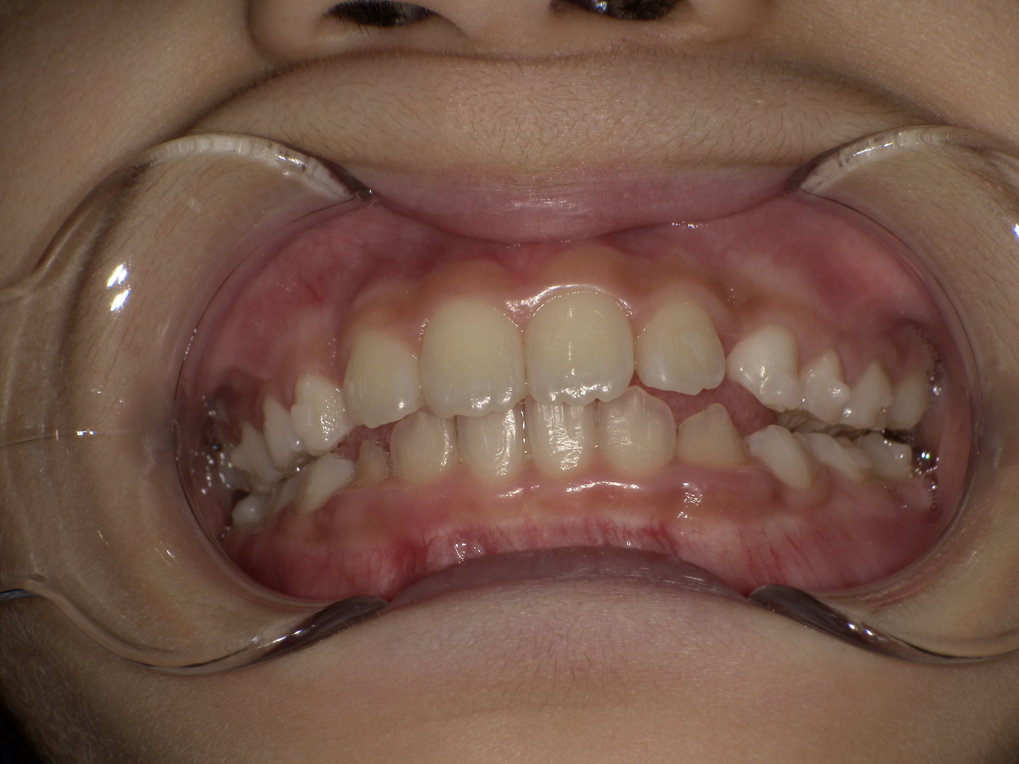 インビザラインファースト