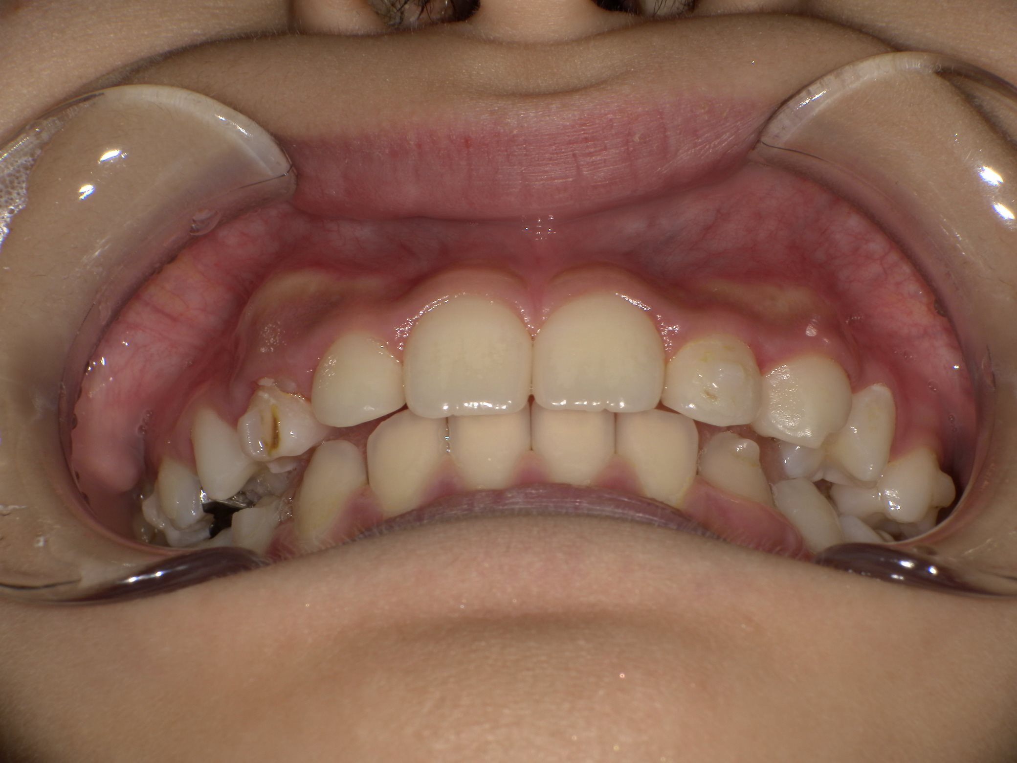 インビザラインファースト