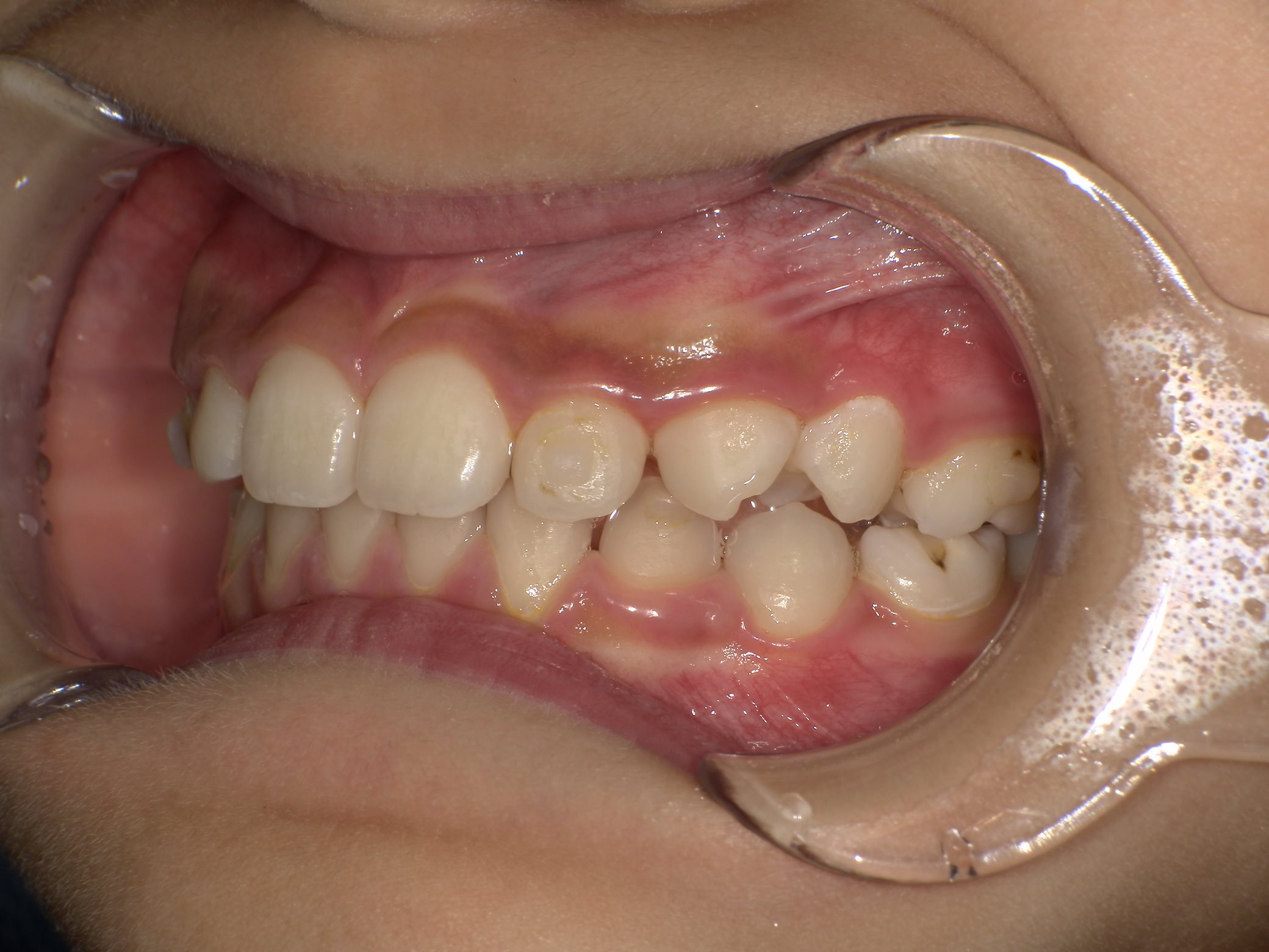 インビザラインファースト