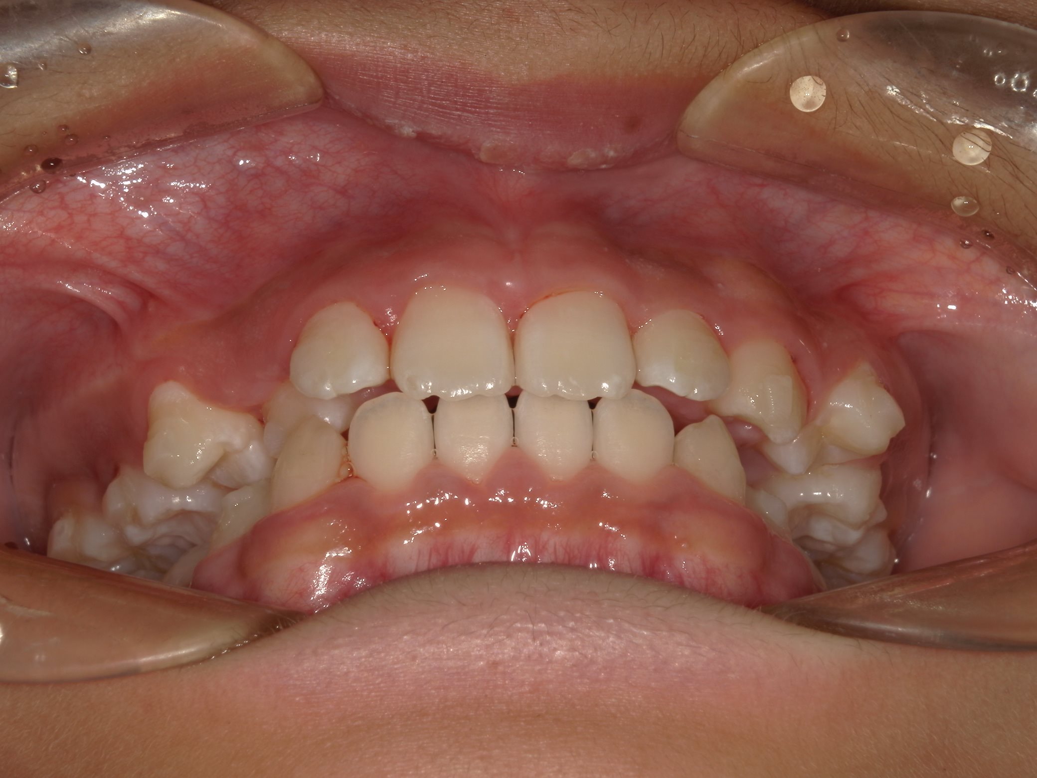 インビザラインファースト