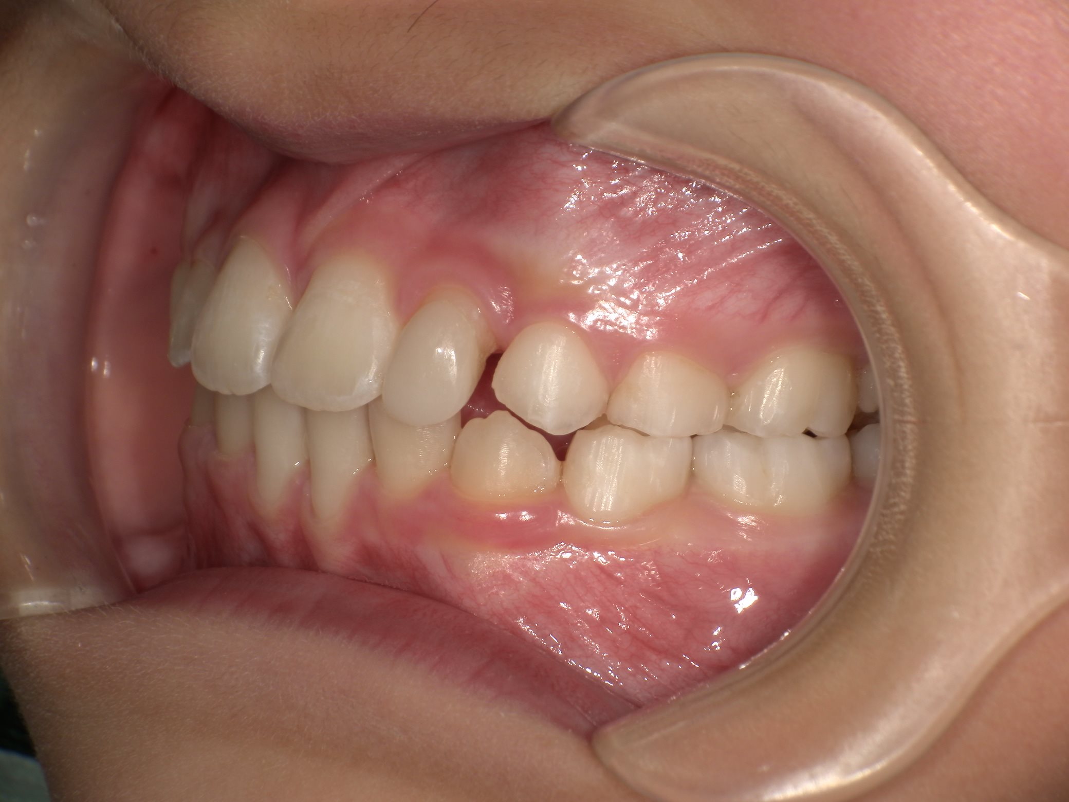 インビザラインファースト