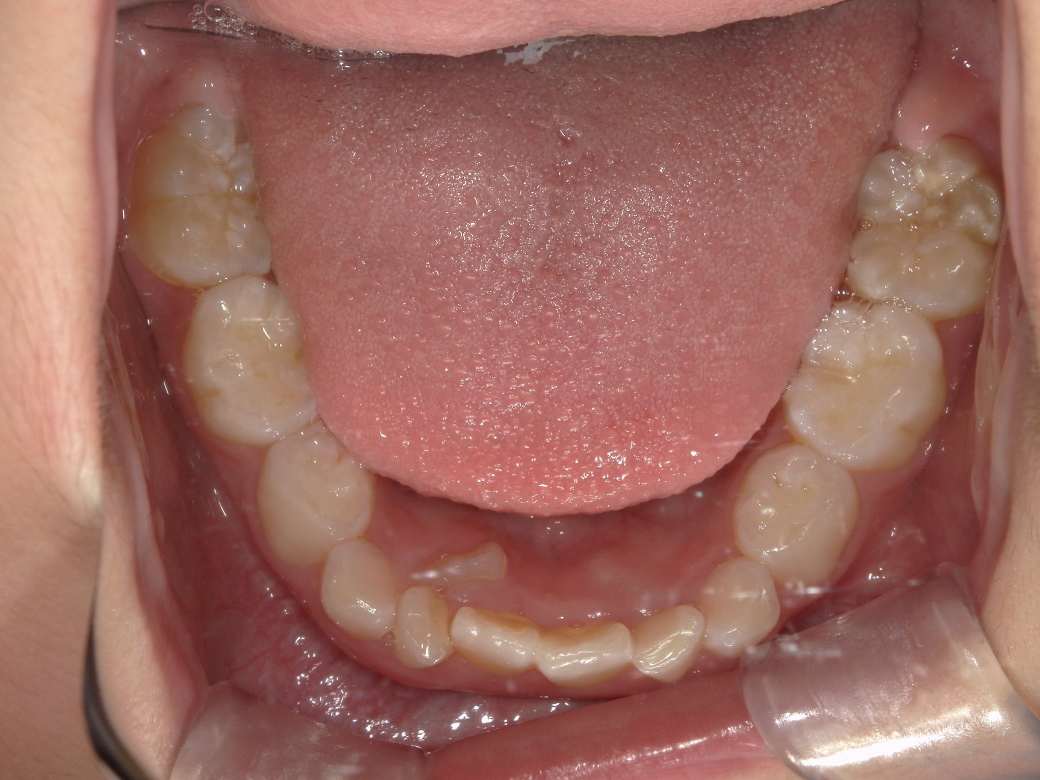 インビザラインファースト