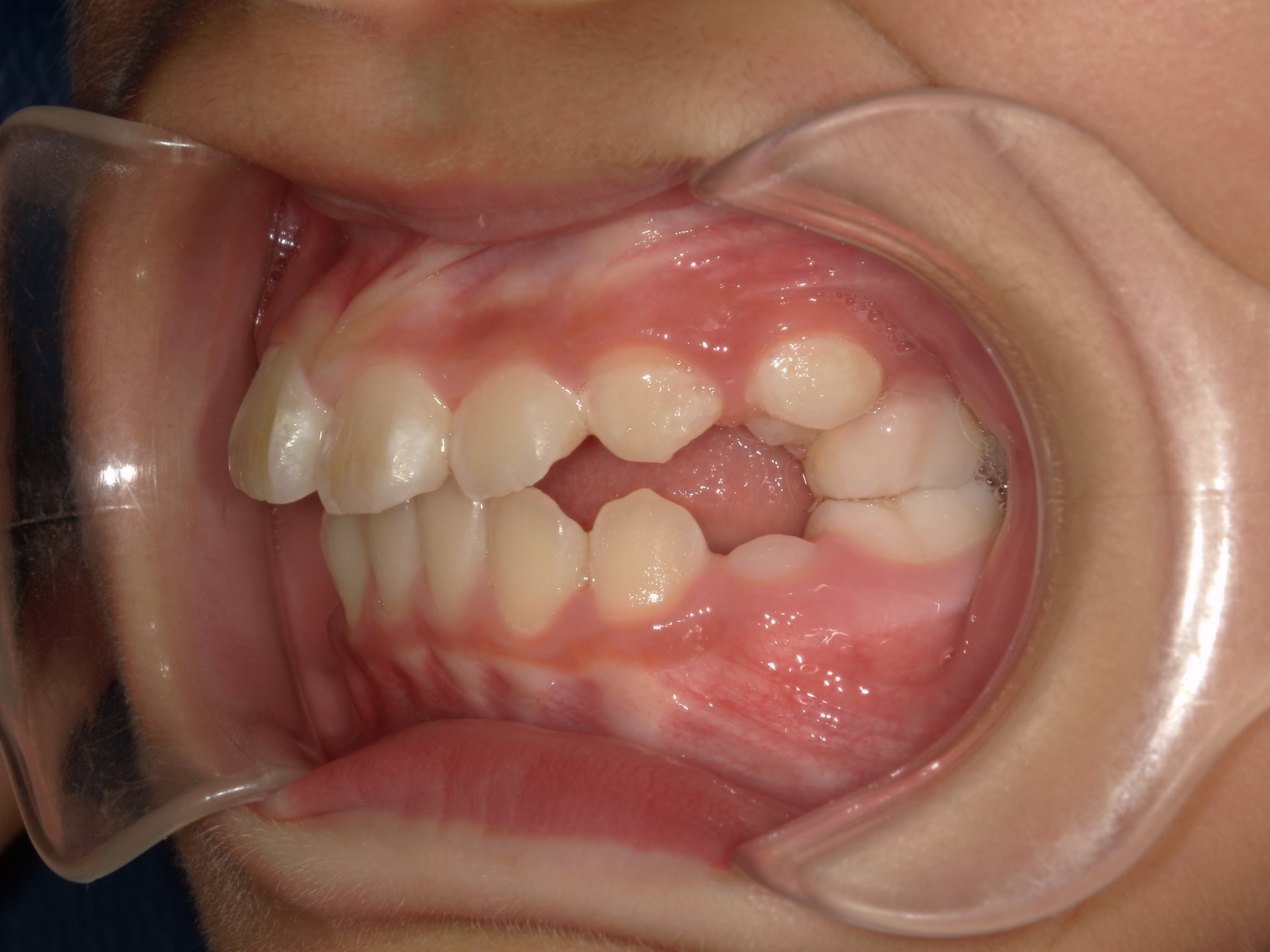 インビザラインファースト