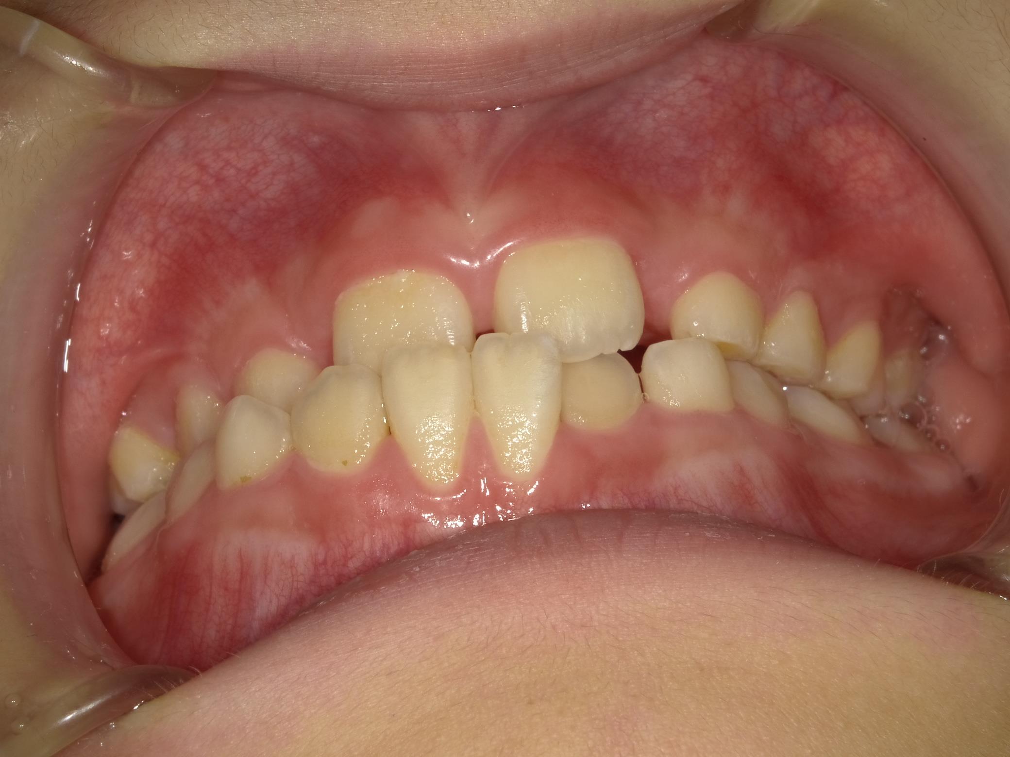 インビザラインファースト