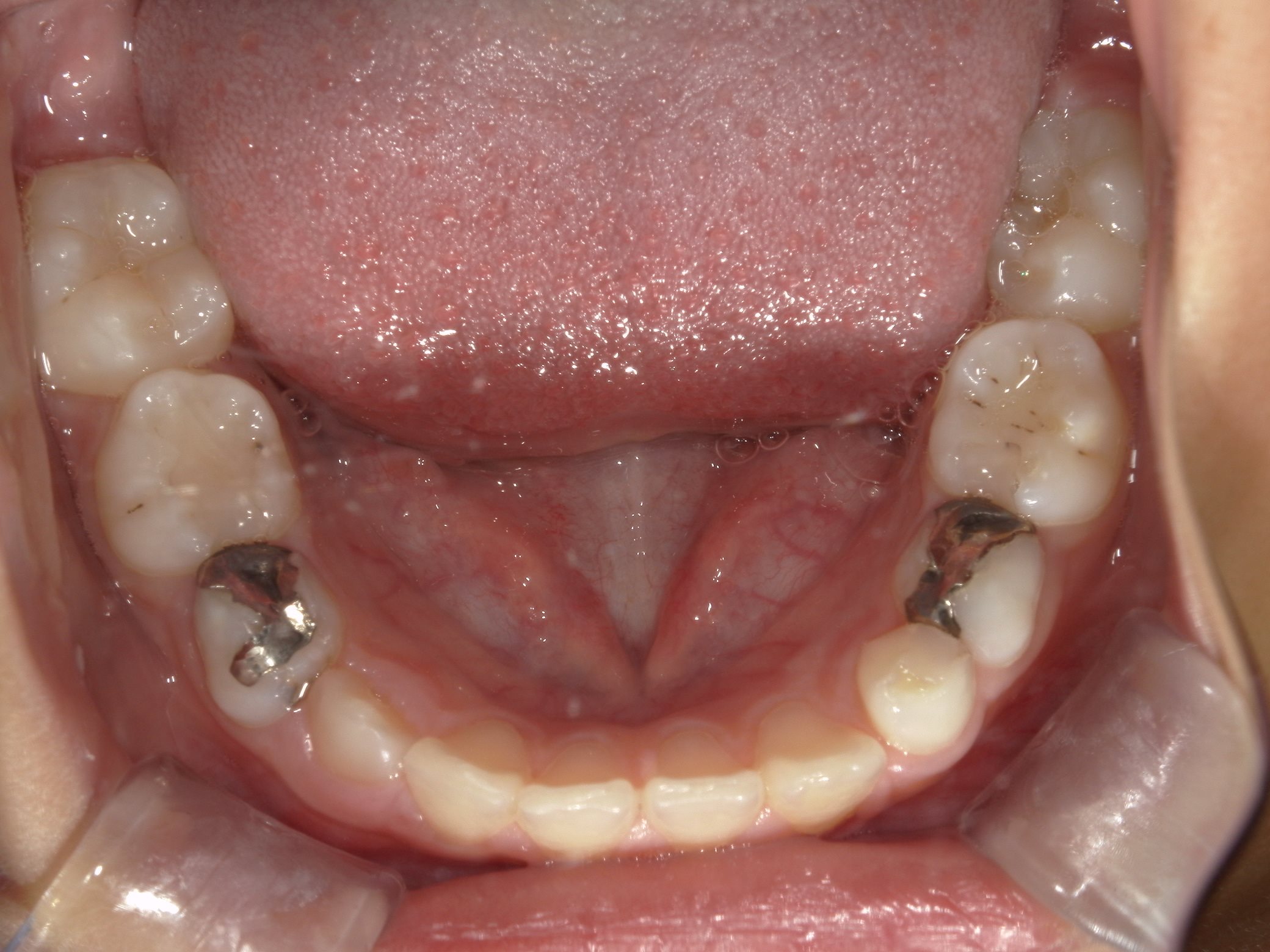 インビザラインファースト