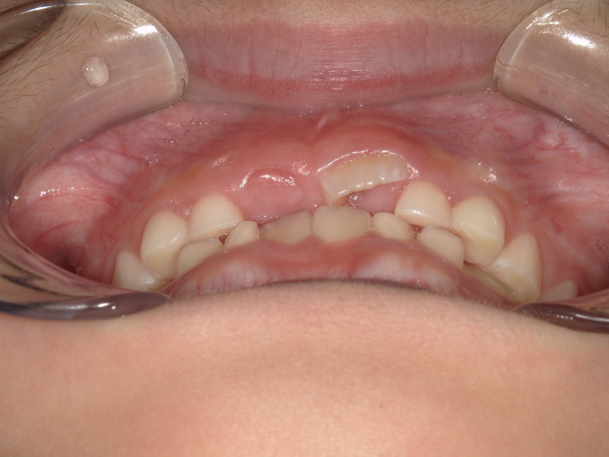 インビザラインファースト