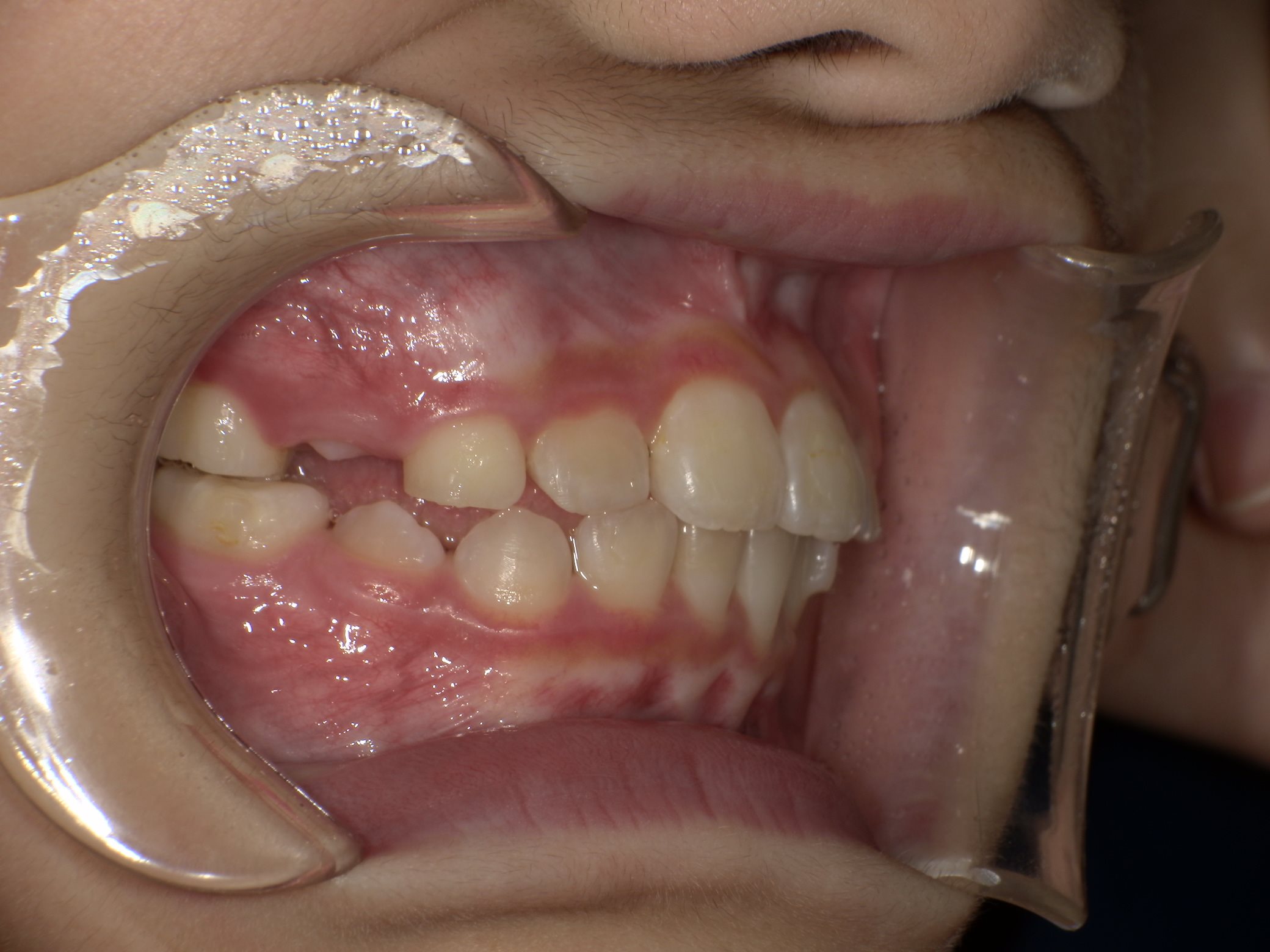 インビザラインファースト