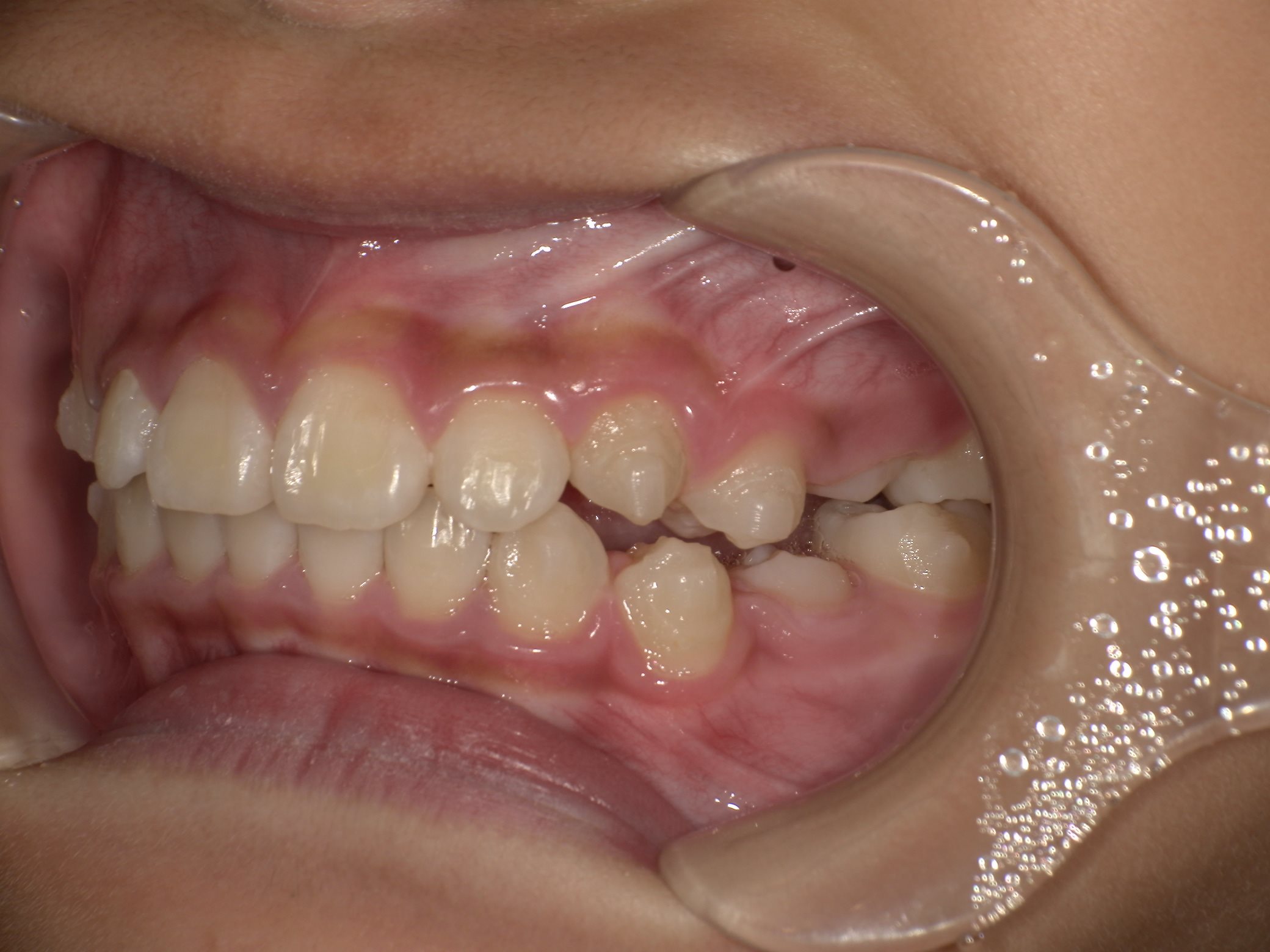 インビザラインファースト