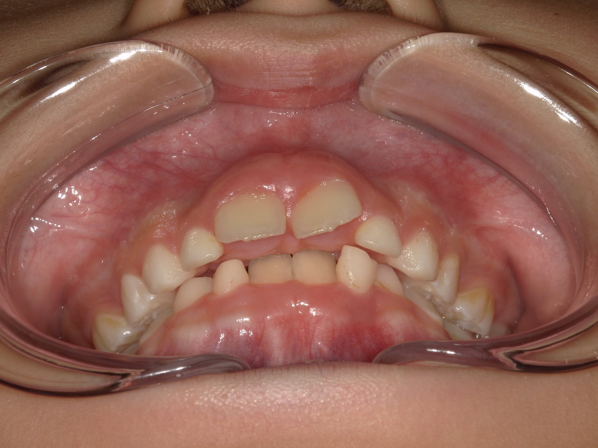 インビザラインファースト