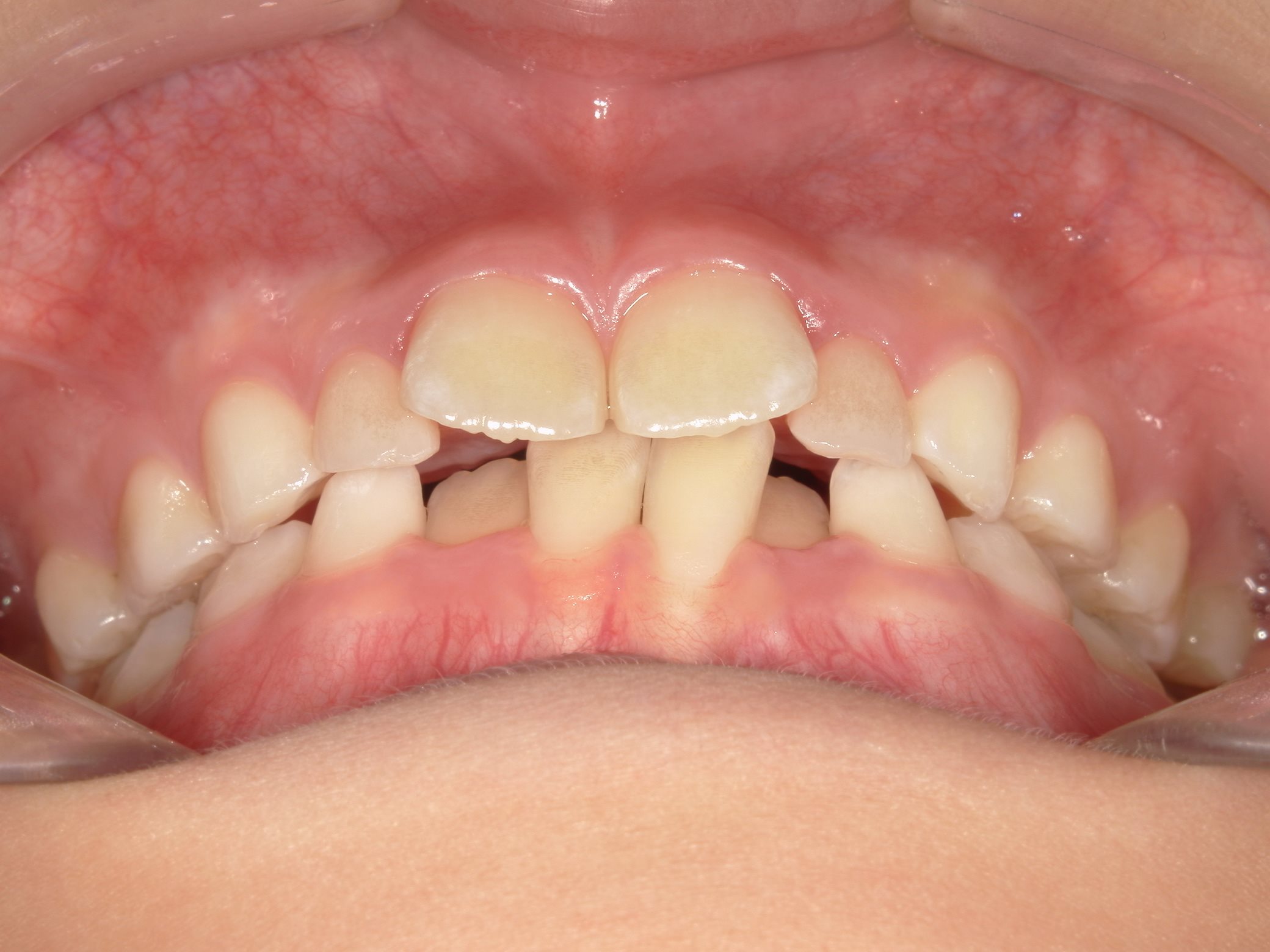 インビザラインファースト