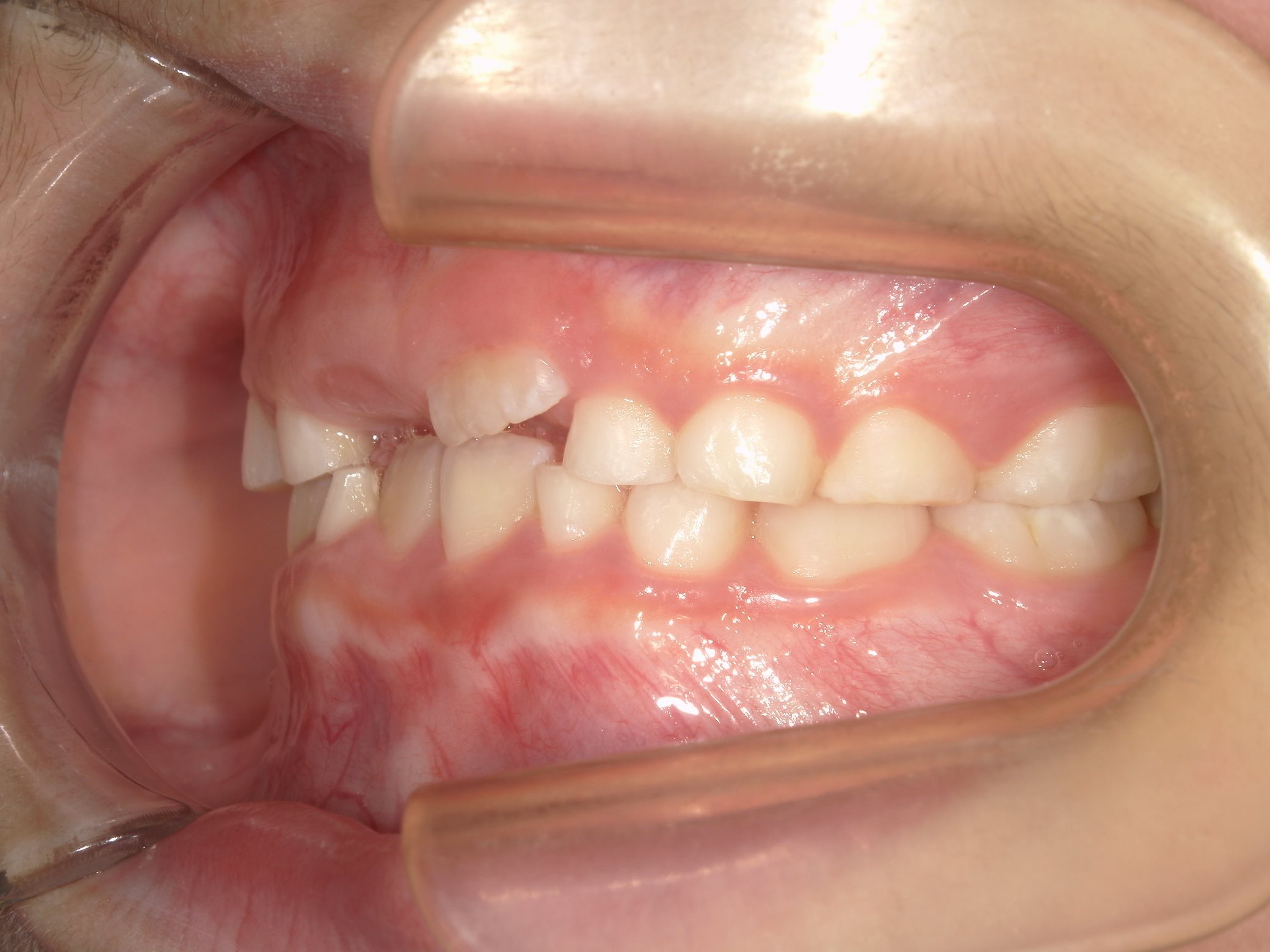 インビザラインファースト