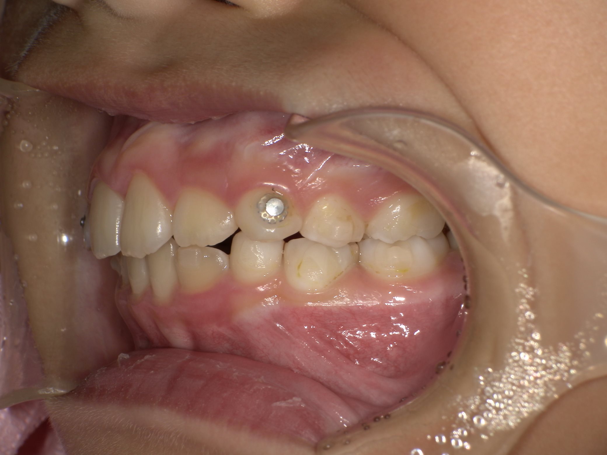 インビザラインファースト