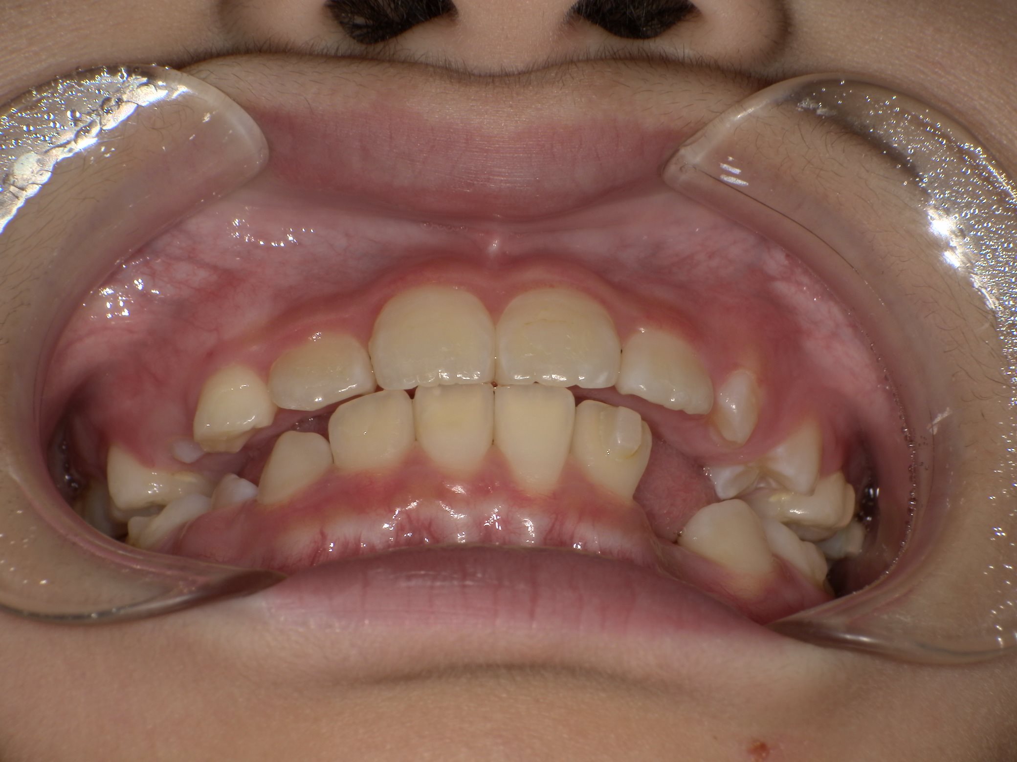 インビザラインファースト