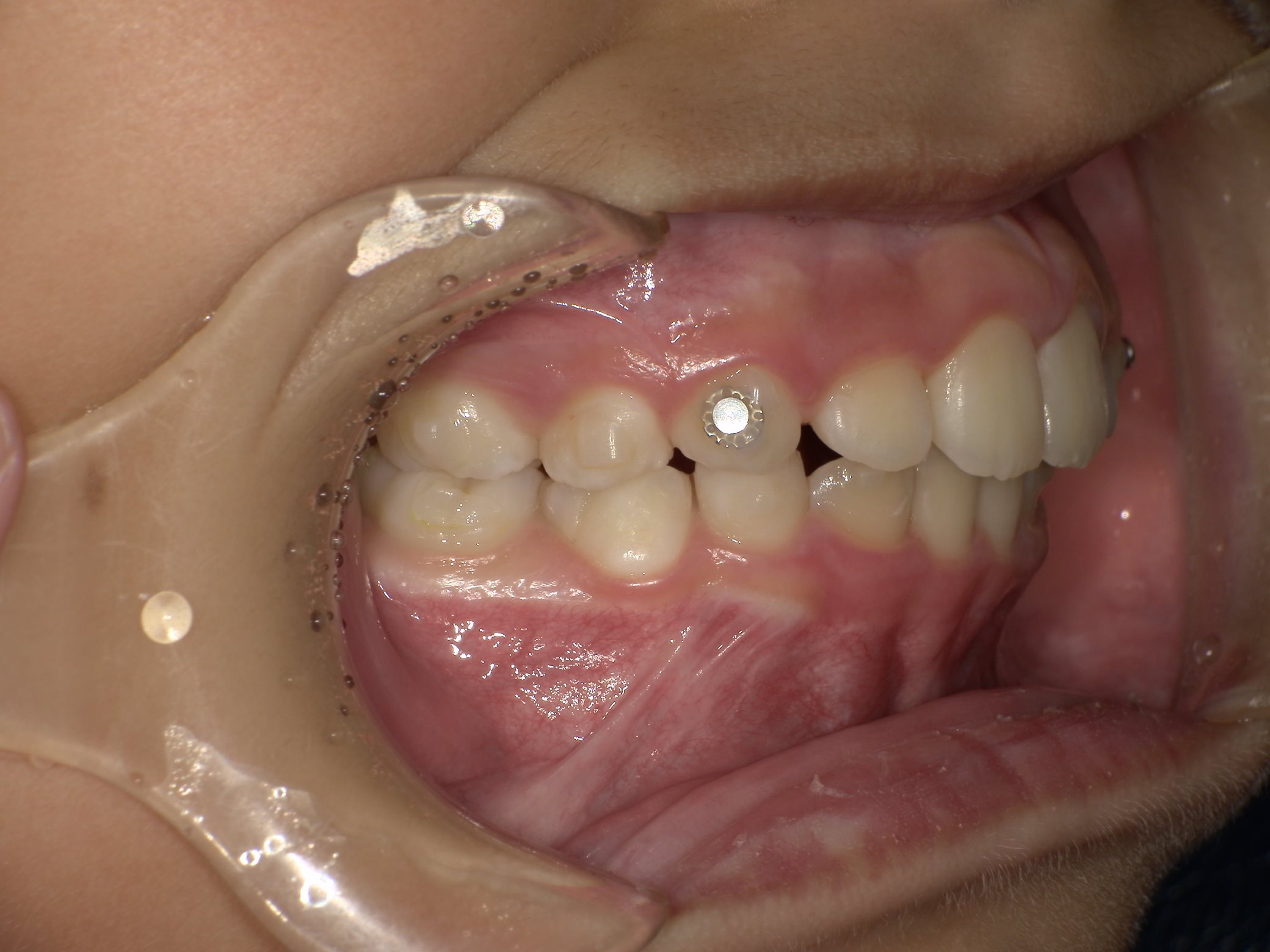 インビザラインファースト