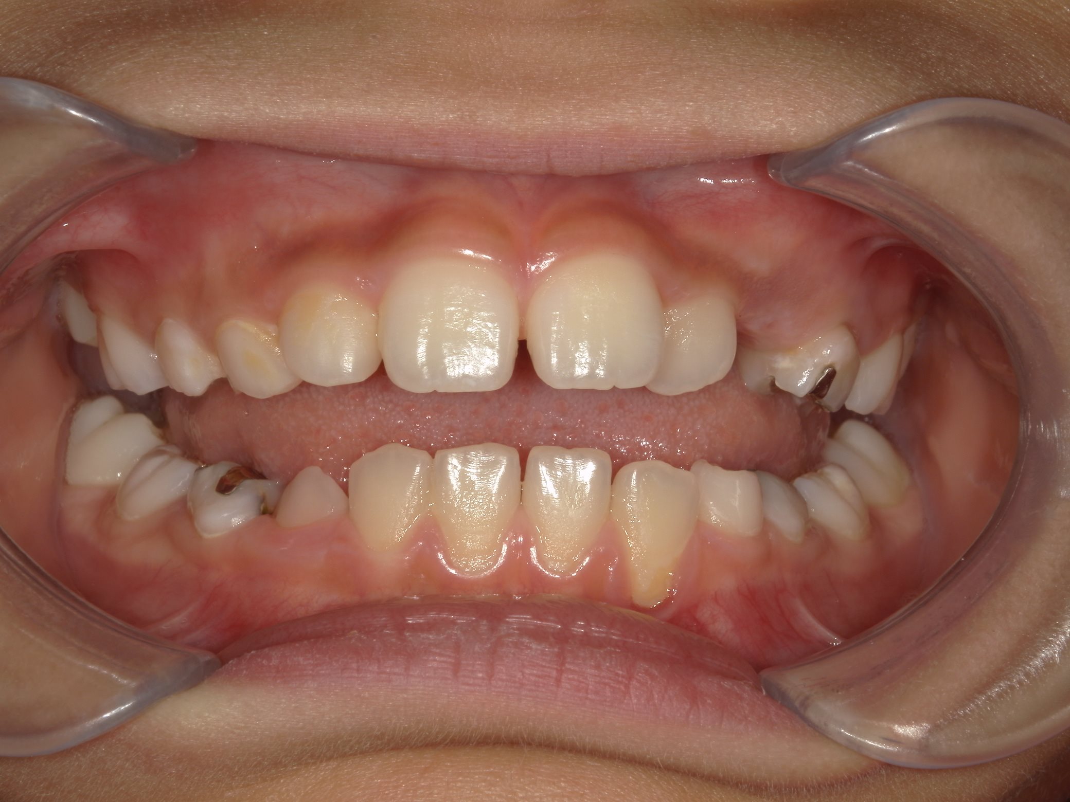 インビザラインファースト