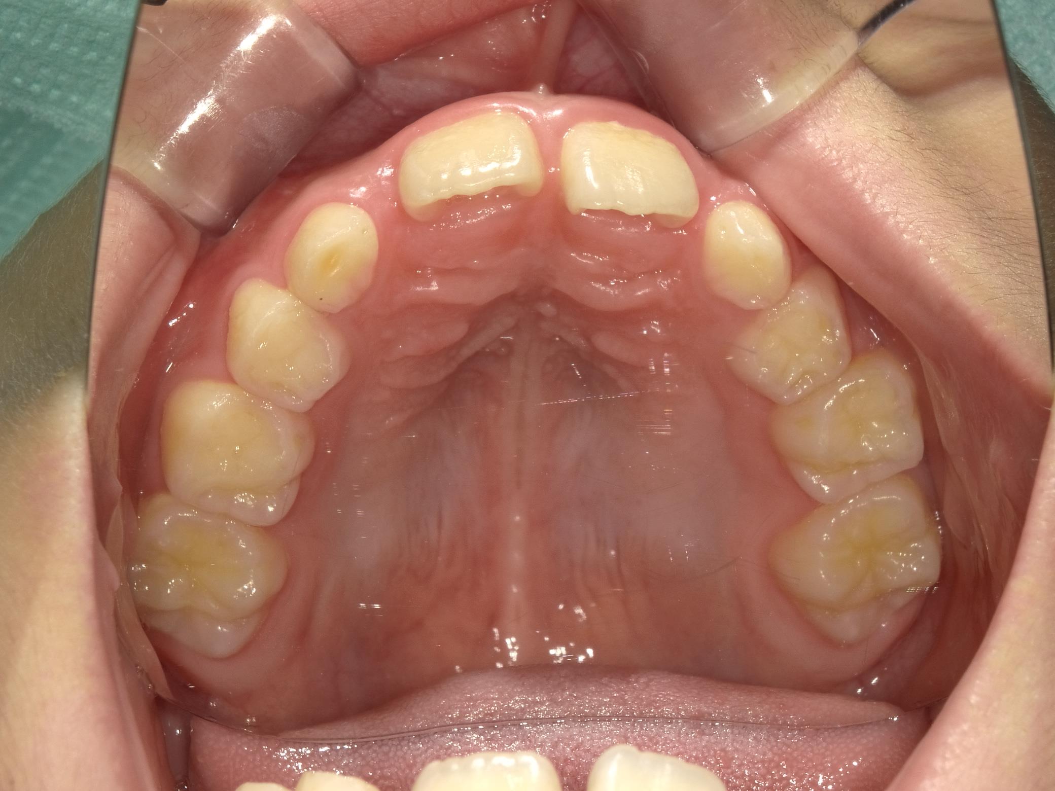 インビザラインファースト