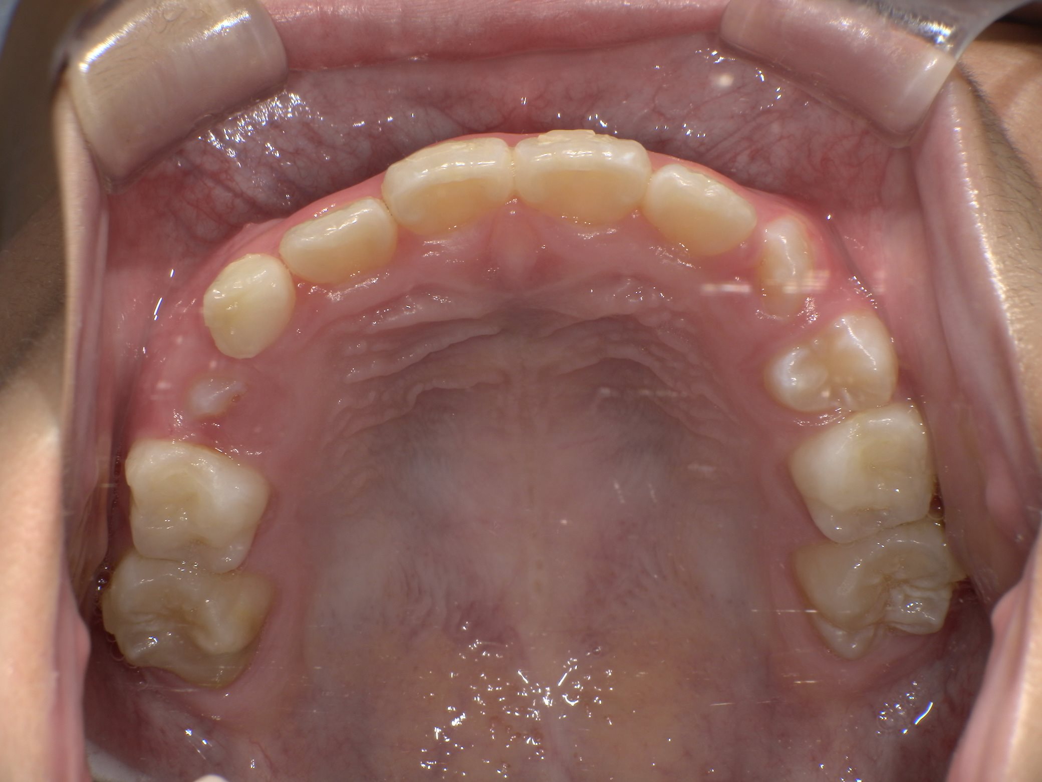 インビザラインファースト