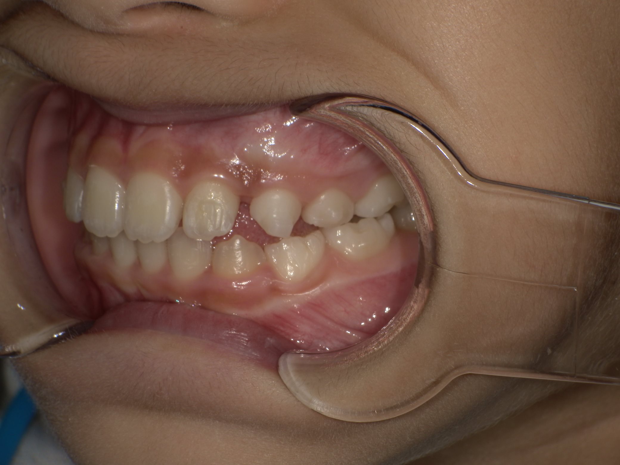 インビザラインファースト