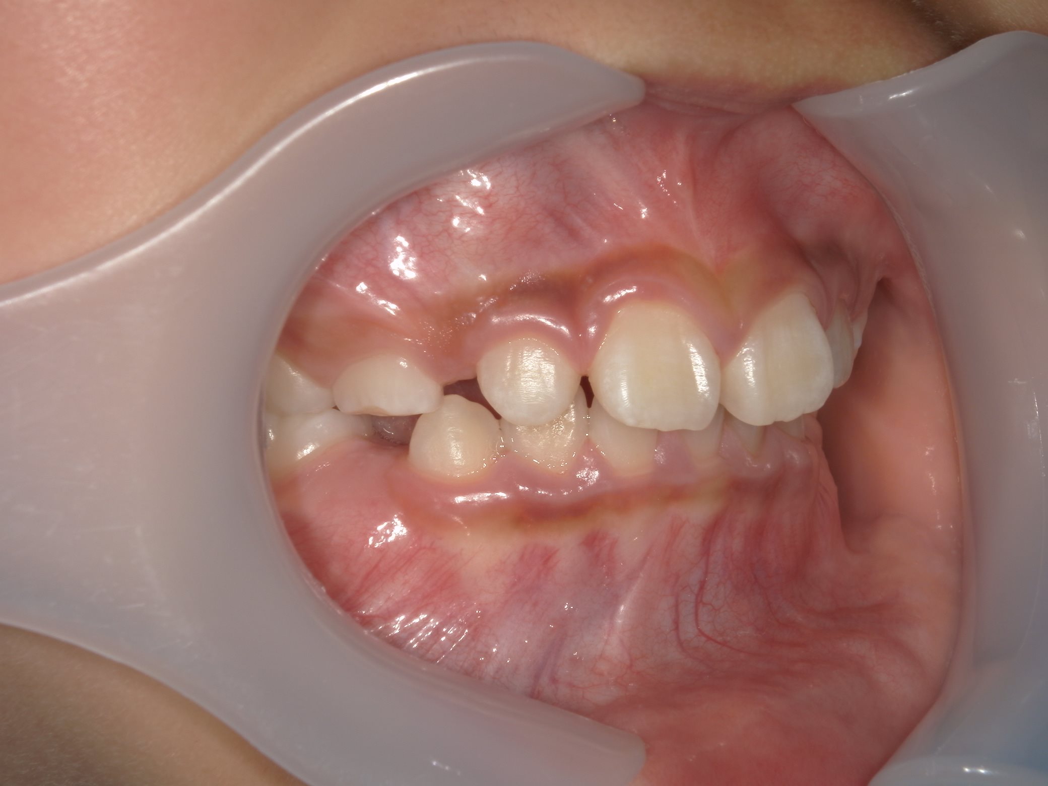 インビザラインファースト