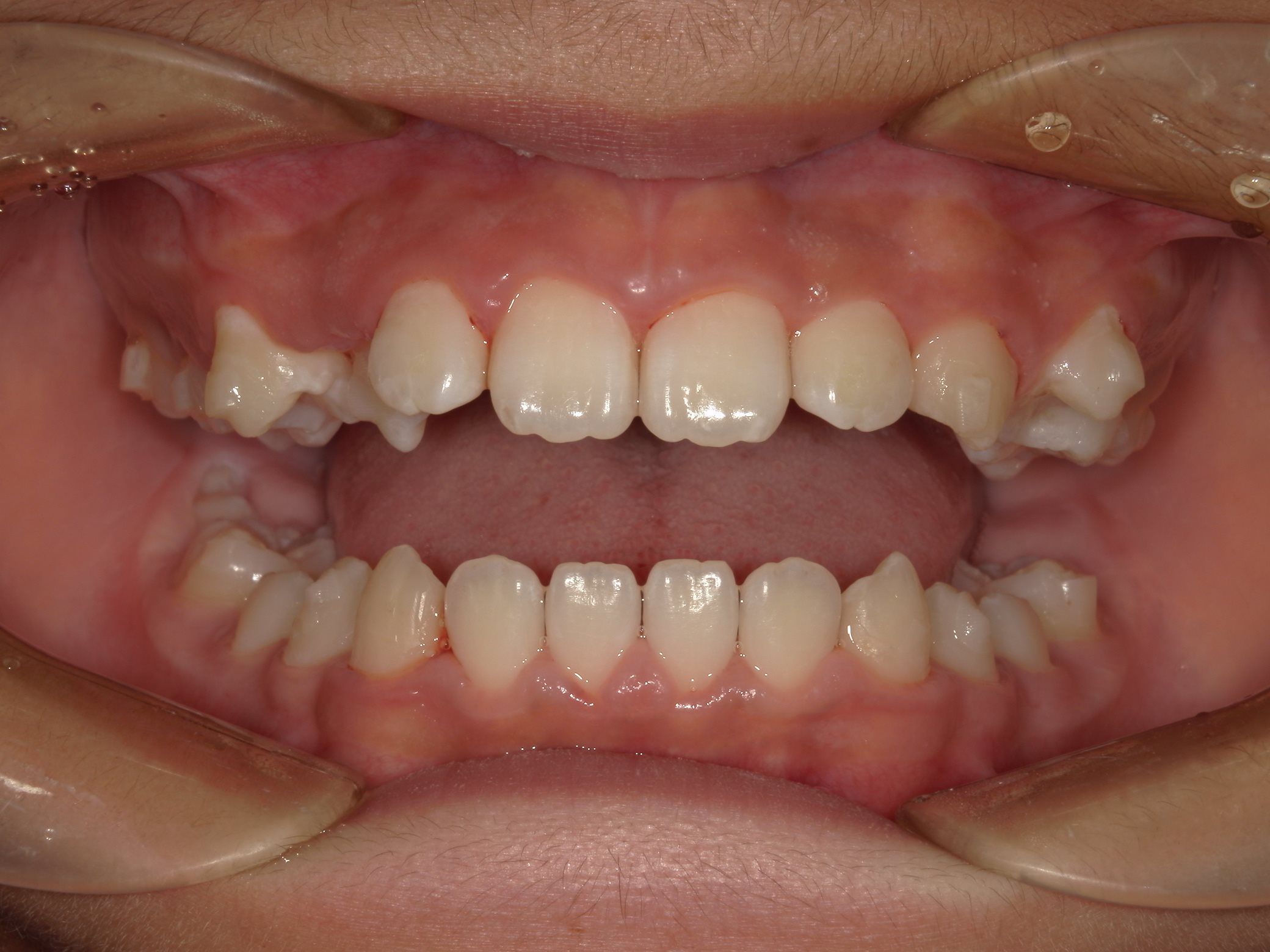 インビザラインファースト