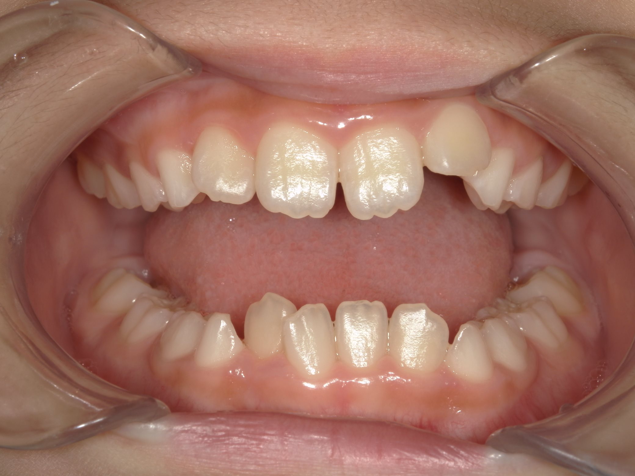 インビザラインファースト