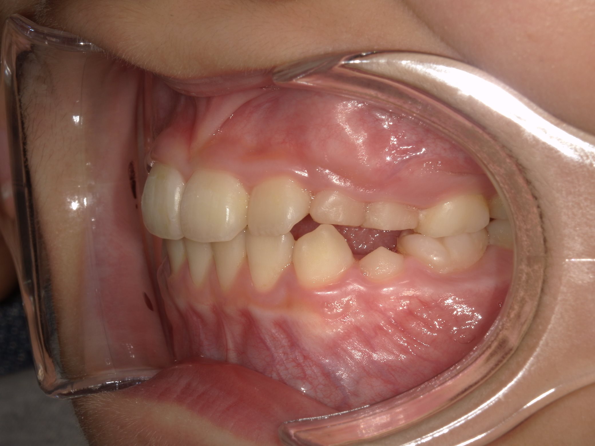 インビザラインファースト